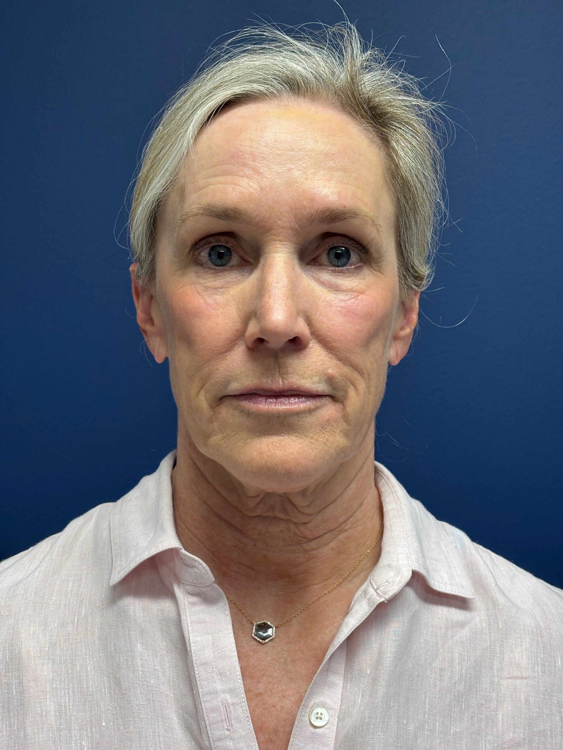 Facelift-Facial-Fat-Grafting-Brow-and-Neck-Lift-Case--9593 | Before Face360 1
