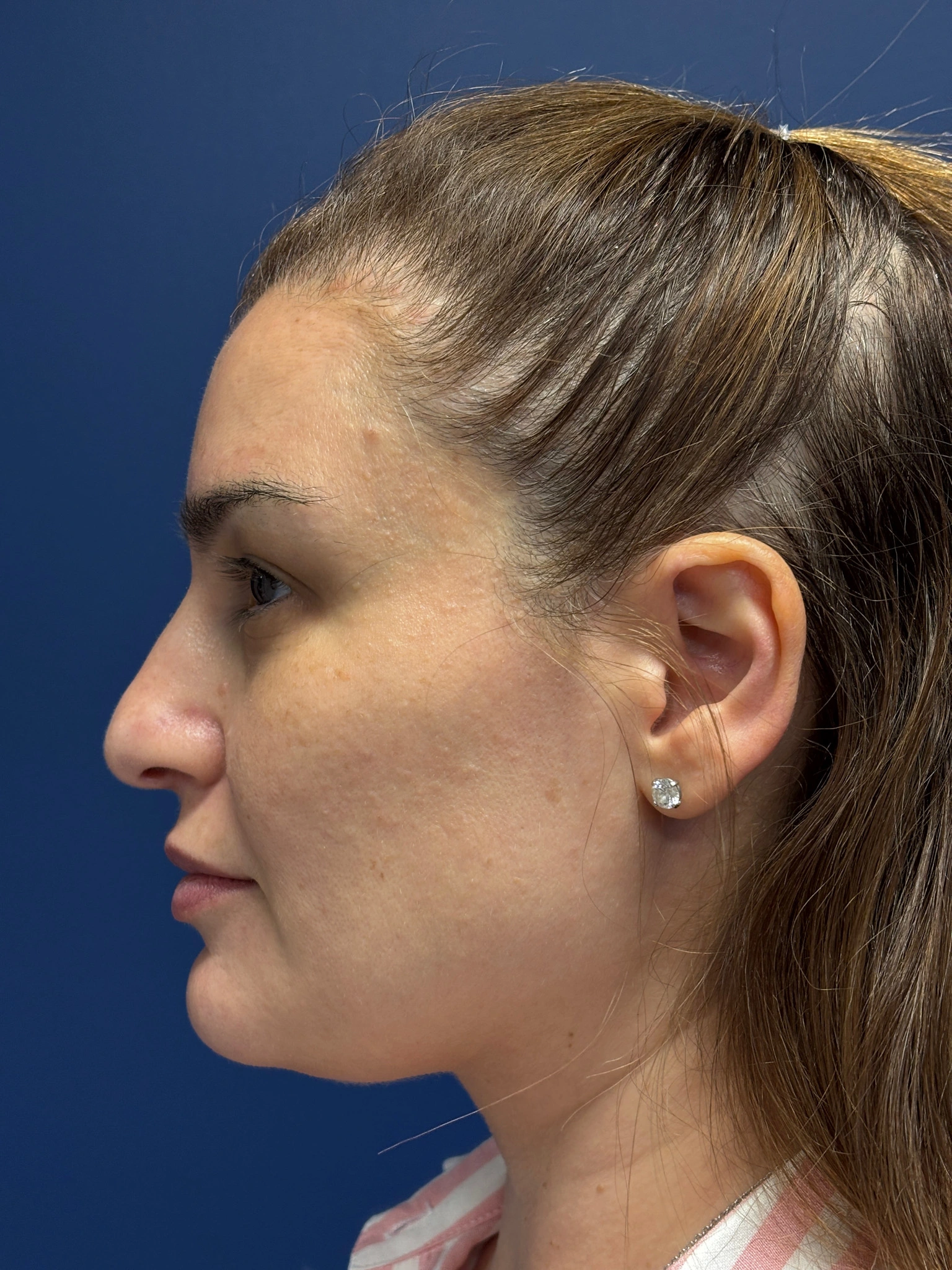 Facelift-and-Facial-Fat-Grafting-Case--7977 | Before Facelift 2