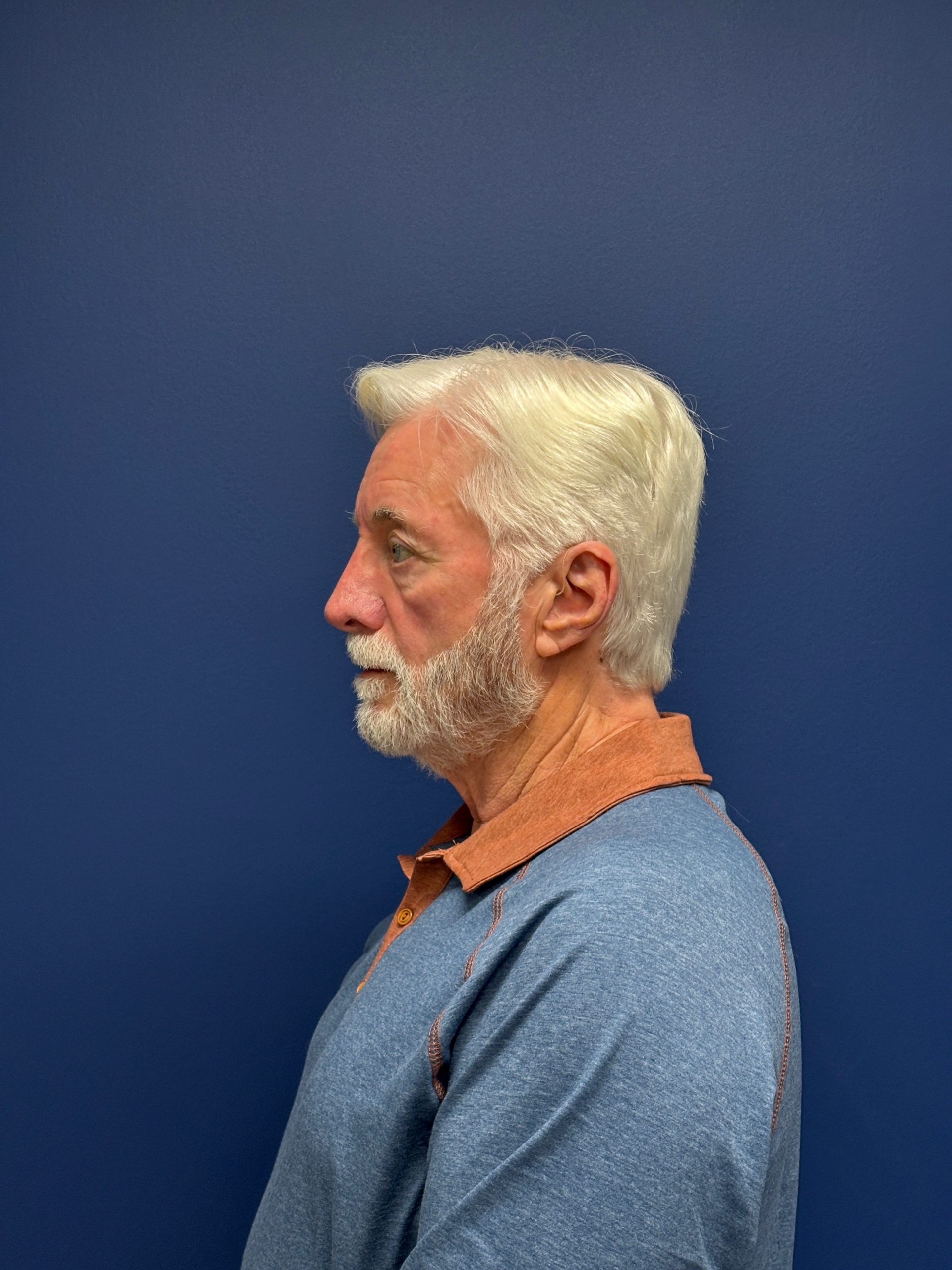 Facelift-Facial-Fat-Graft-Blepheroplasty-Necklift-Case--7796 | Before Face360 2