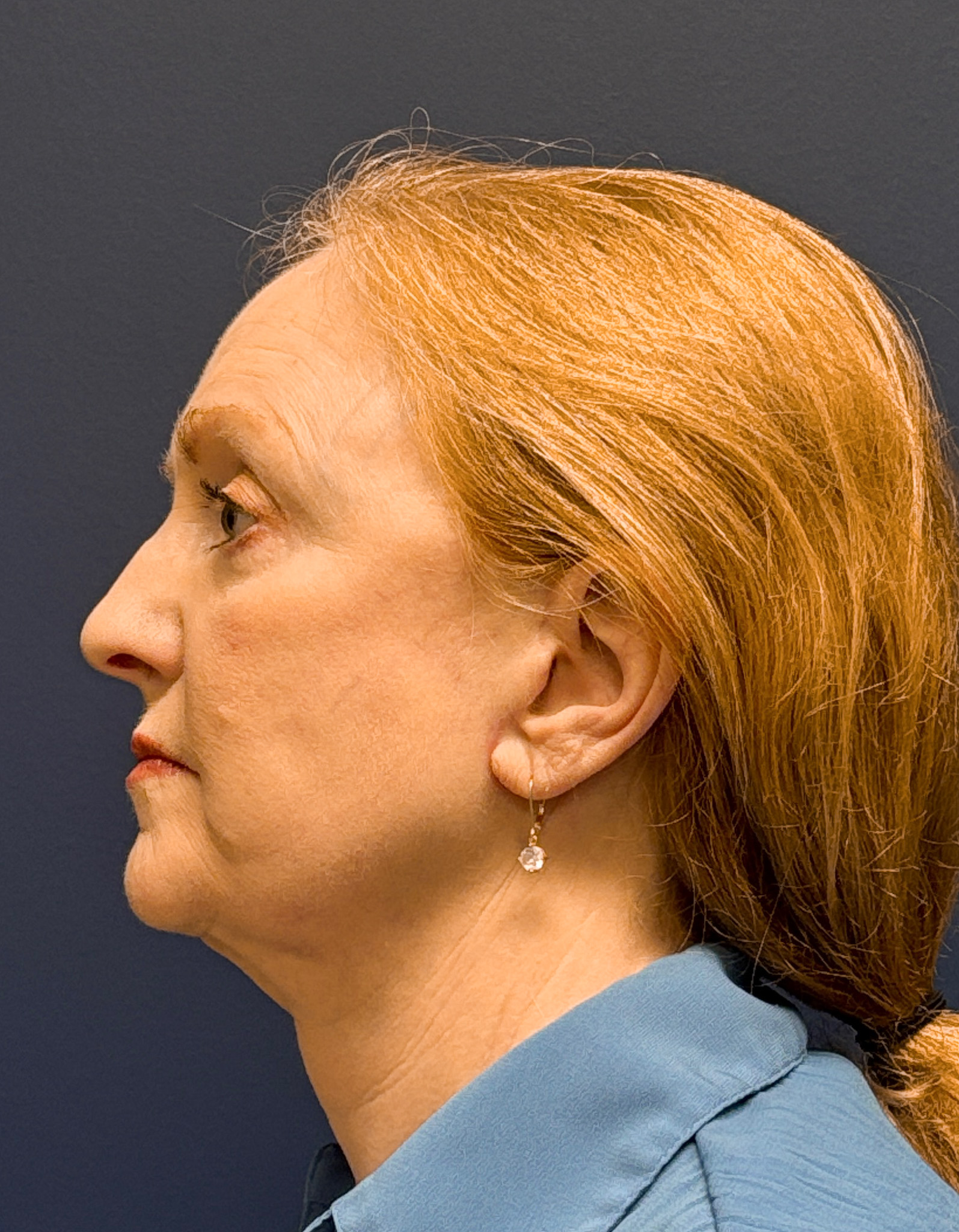 Facelift-Facial-Fat-Graft-Blepharoplasty-Necklift-Case--7934 | After Face360 2