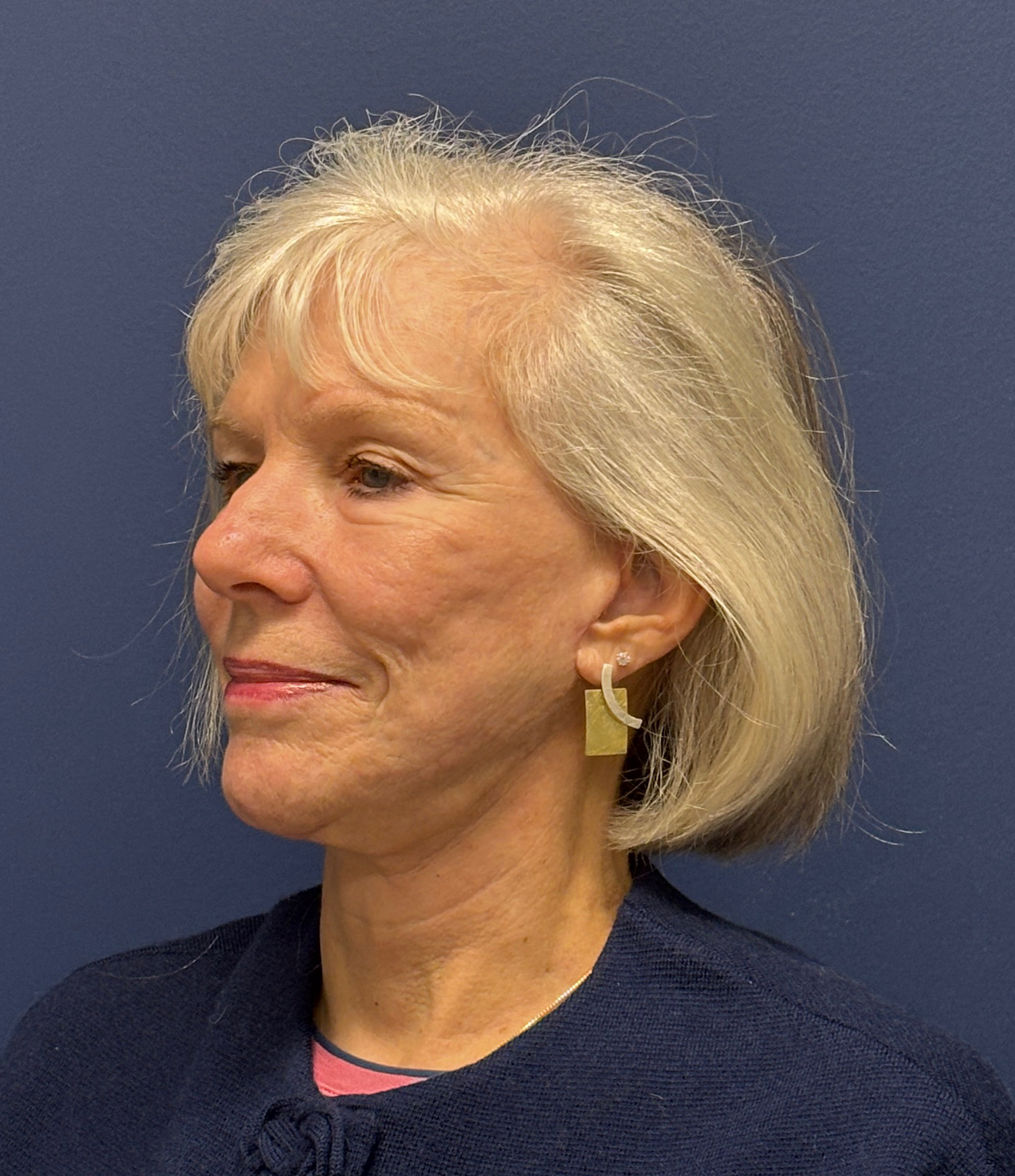 Facelift-Facial-Fat-Grafting-Neck-Lift-Case--1414 | After Face360 4