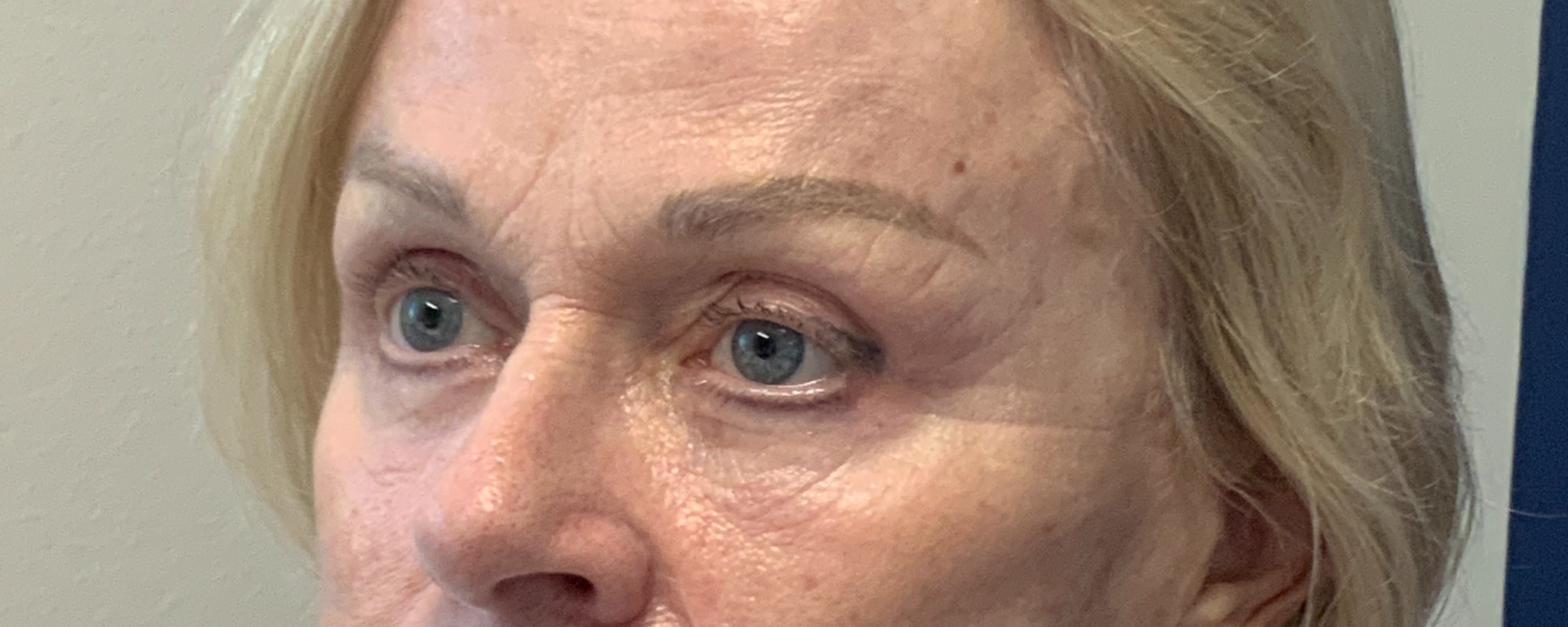 Blepharoplasty-and-Brow-Lift-Case--3108 | Before Brow Lift 3