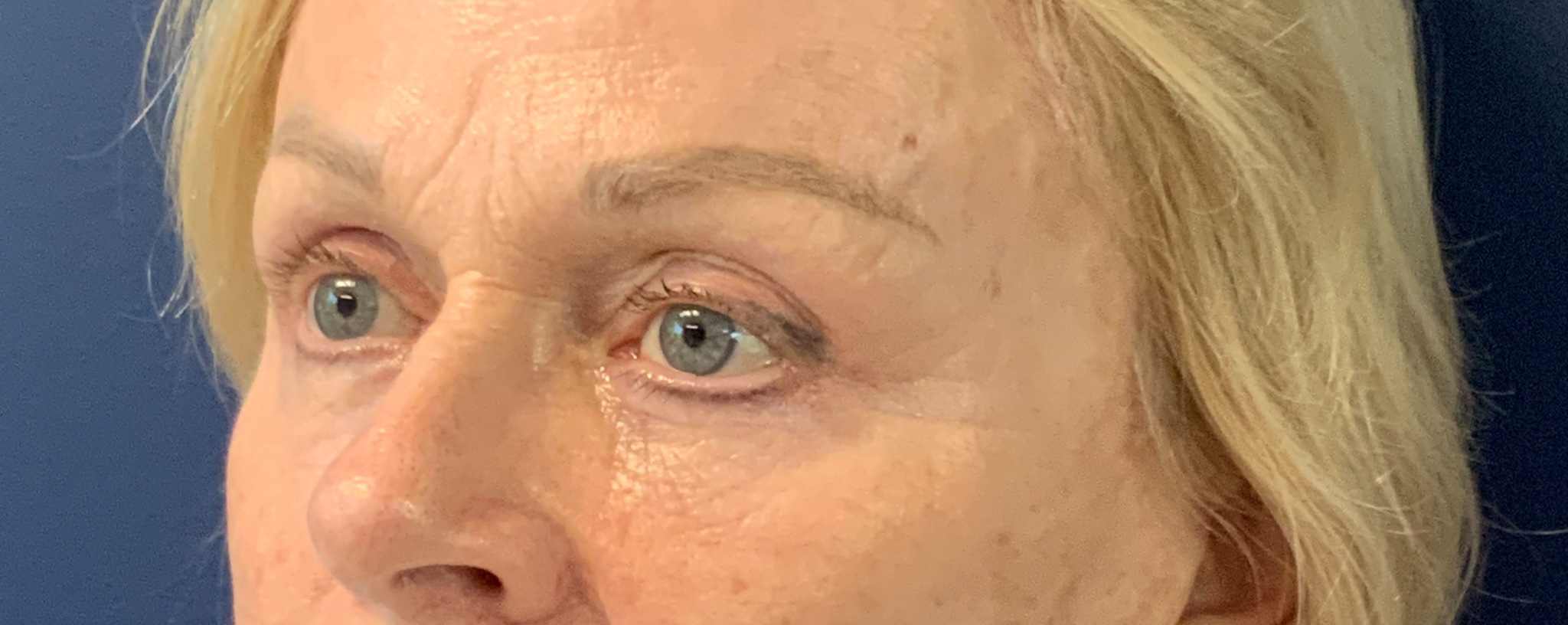 Blepharoplasty-and-Brow-Lift-Case--3108 | After Brow Lift 3
