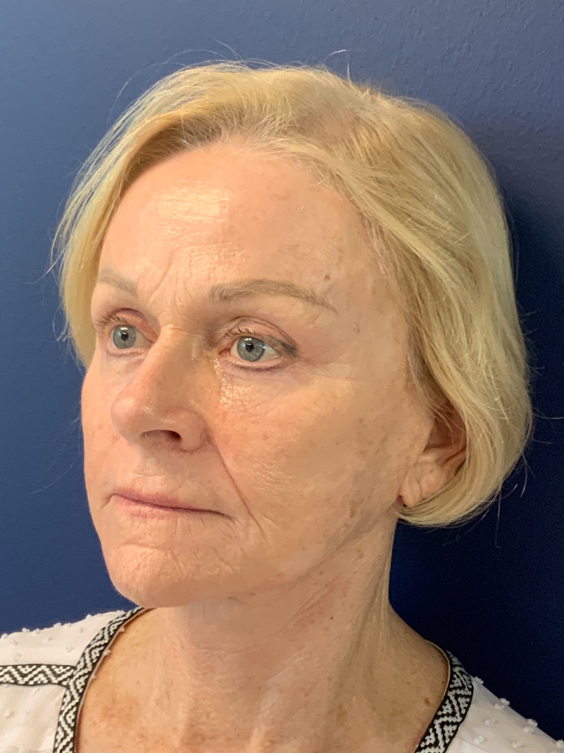 Facelift-360-Facial-Fat-Grafting-Blepharoplasty-Brow-and-Neck-Lift-Case--1433 | After Face360 3
