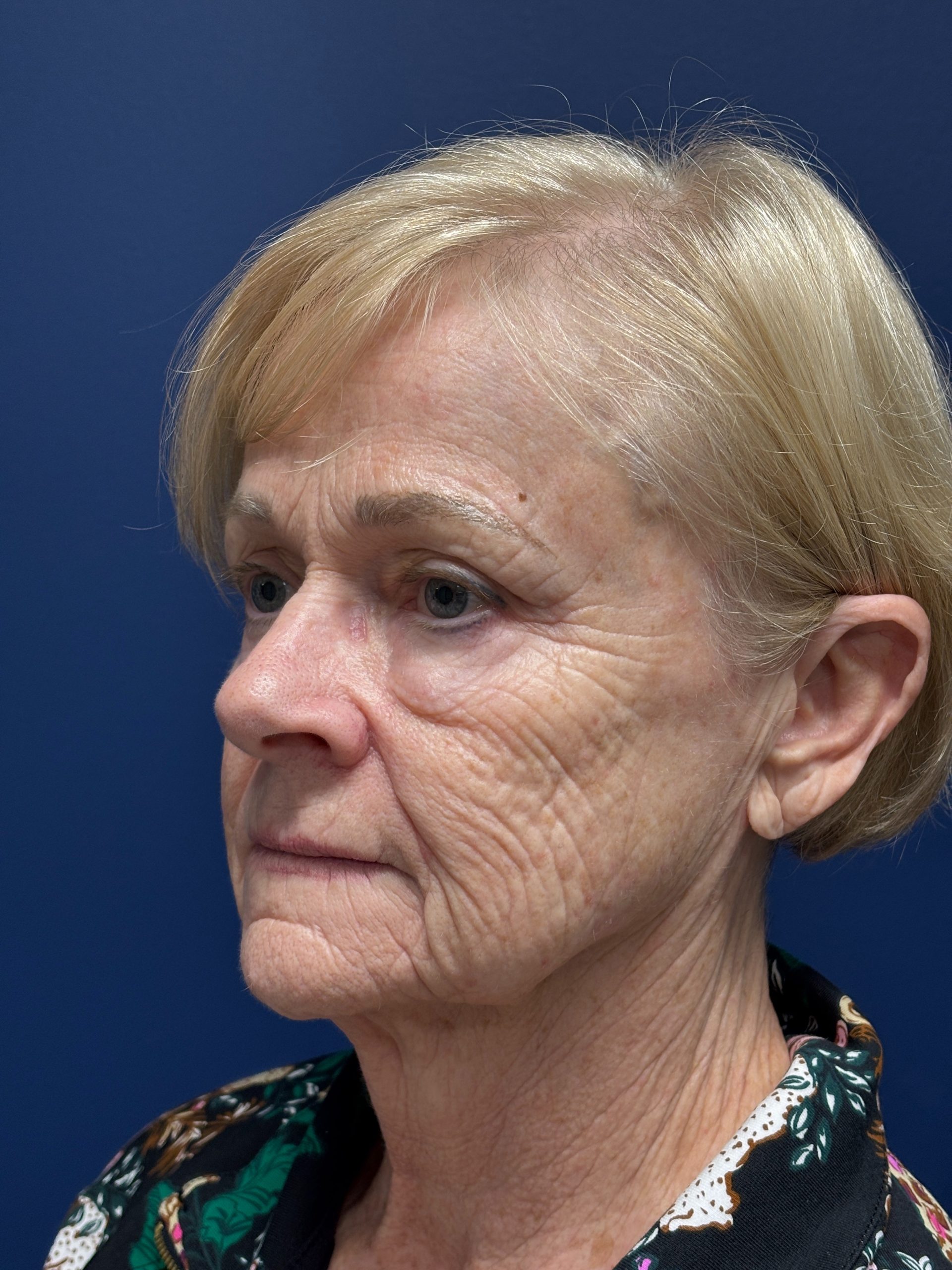 Facelift-360-Facial-Fat-Grafting-Blepharoplasty-Brow-and-Neck-Lift-Case--1433 | Before Face360 3