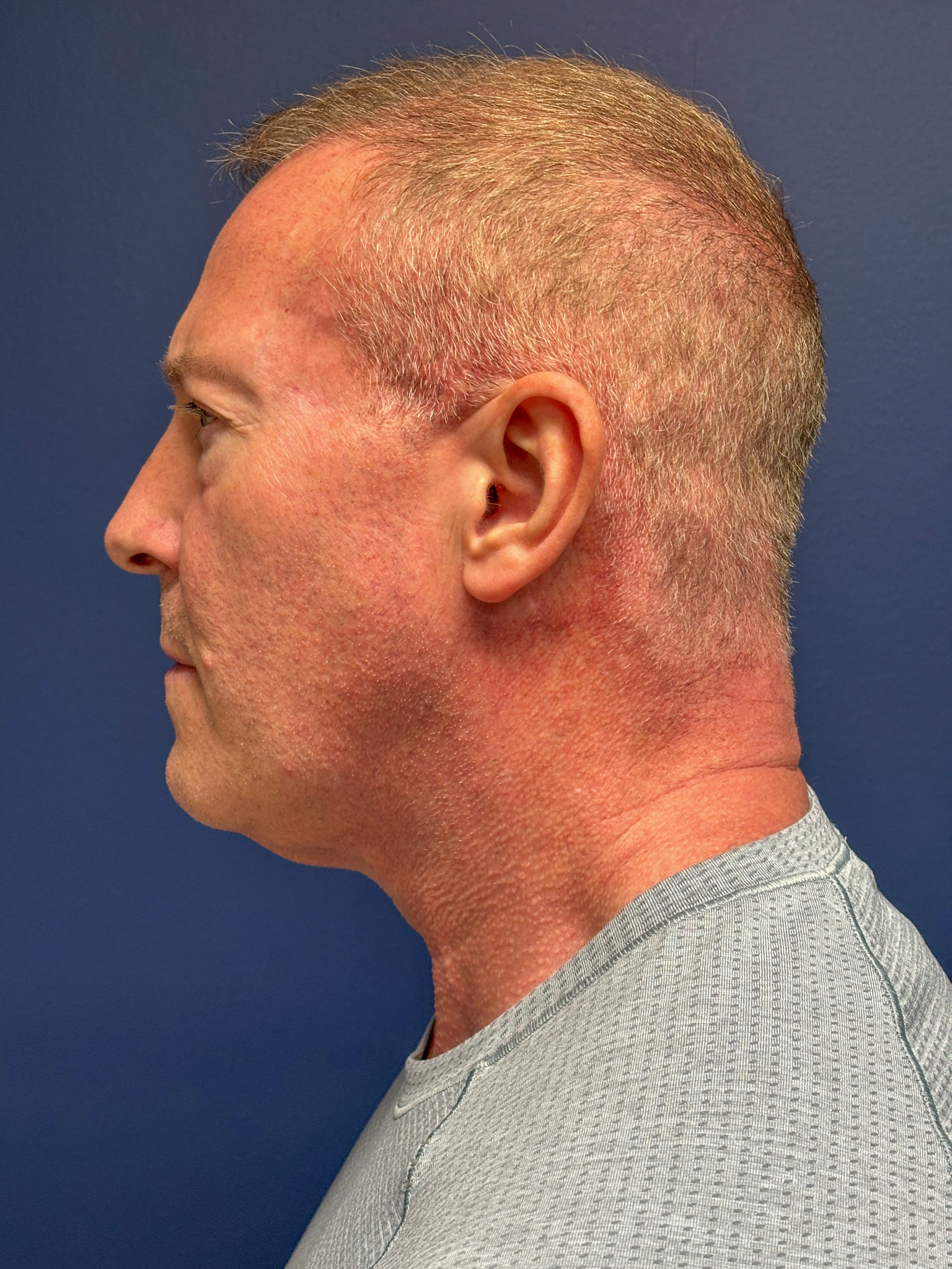 Facelift-Necklift-Blepharoplasty-Case--5535 | Before Face360 2