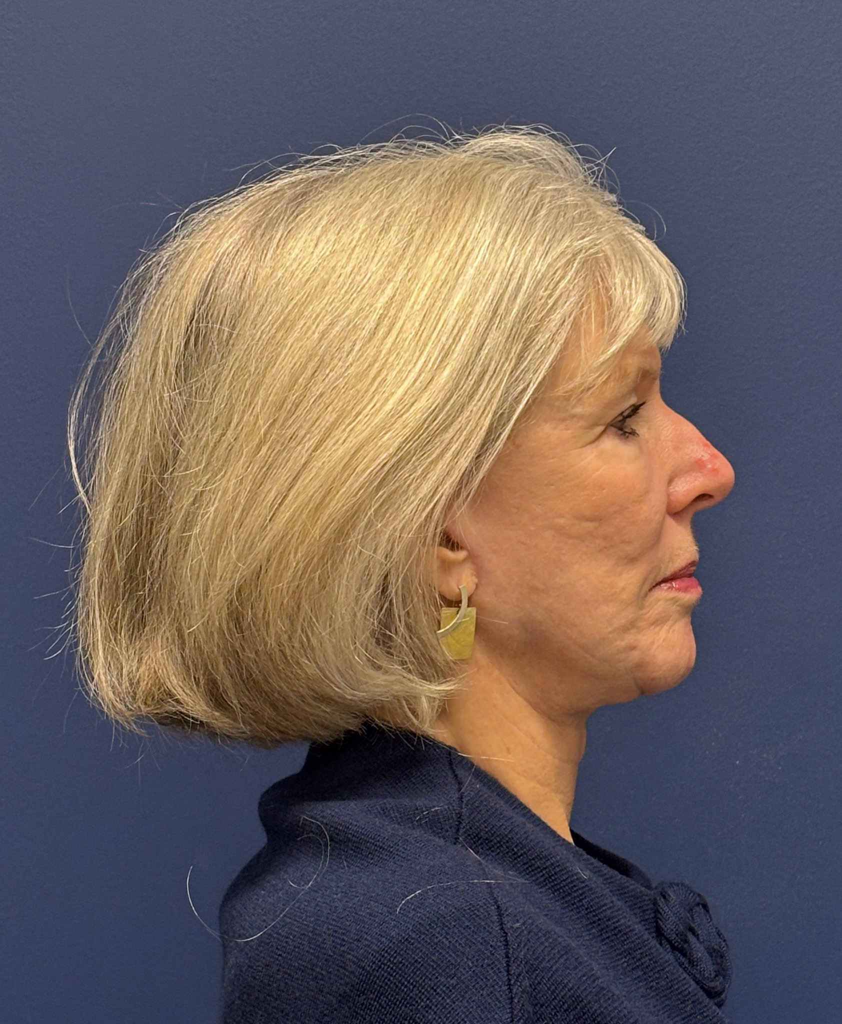 Facelift-Facial-Fat-Grafting-Neck-Lift-Case--1414 | After Face360 3