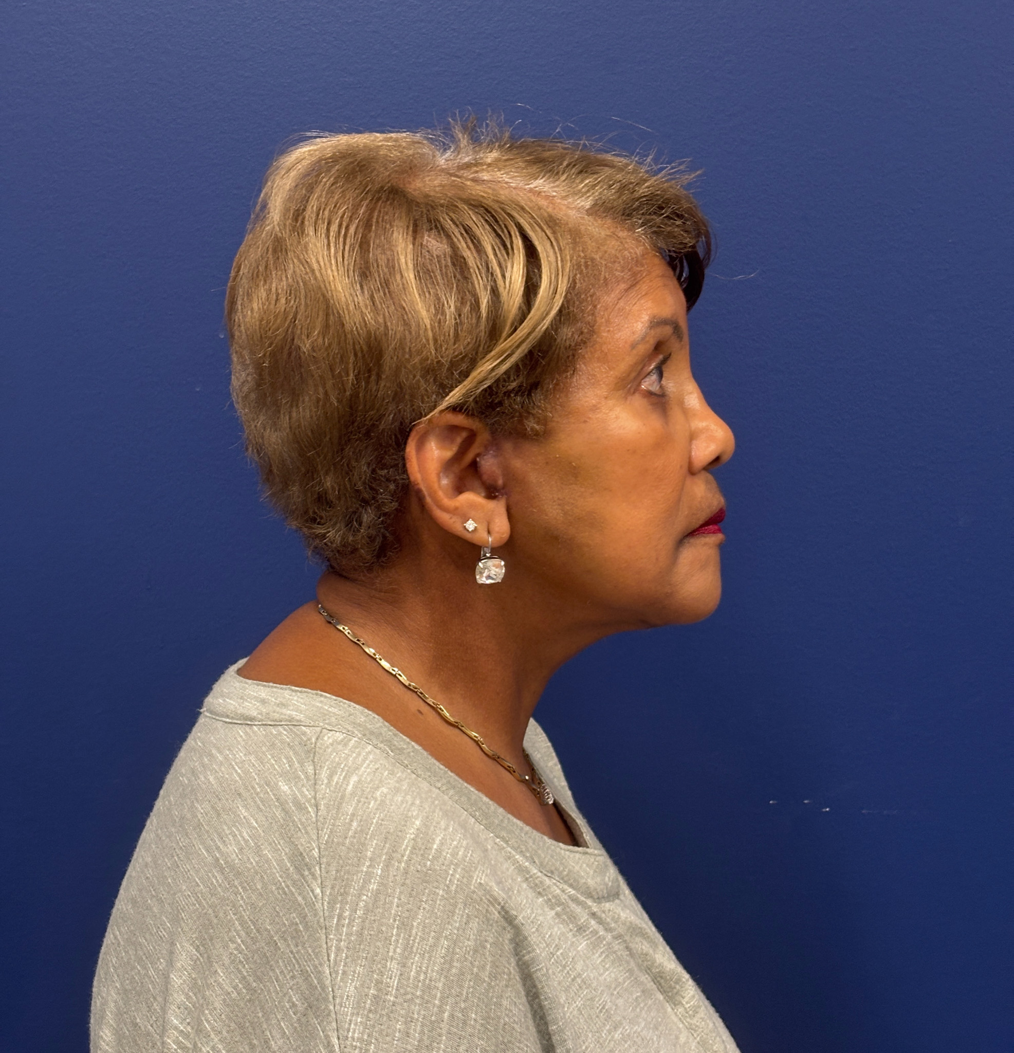 Facelift-Facial-Fat-Graft-Neck-Lift-Case--4262 | After Face360 2