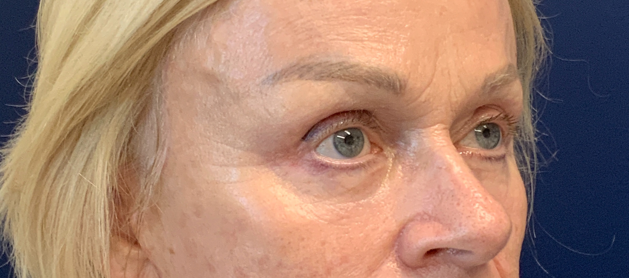Blepharoplasty-and-Brow-Lift-Case--3108 | After Dr. Arjun Kanuri 2