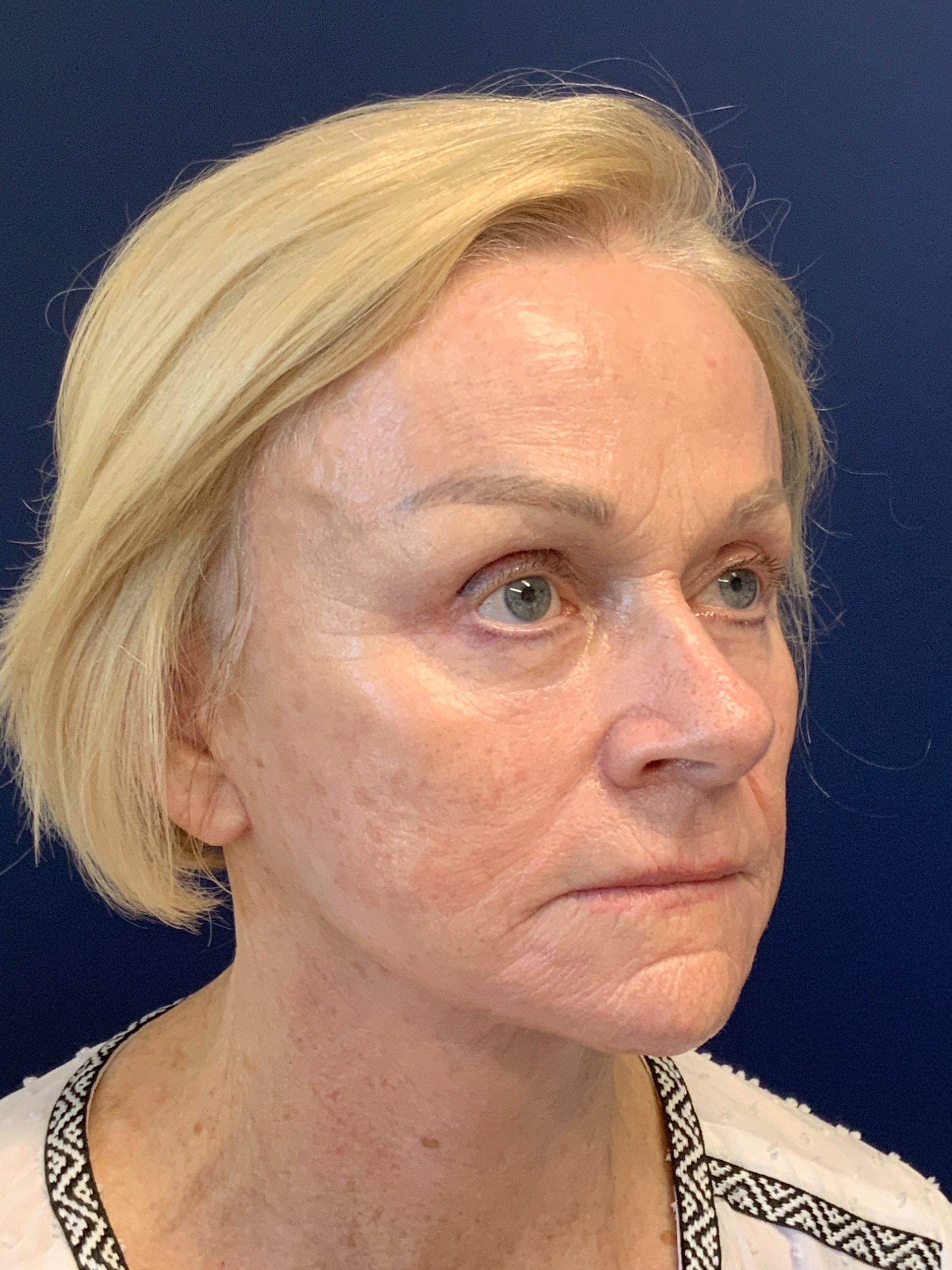 Facelift-360-Facial-Fat-Grafting-Blepharoplasty-Brow-and-Neck-Lift-Case--1433 | After Face360 2