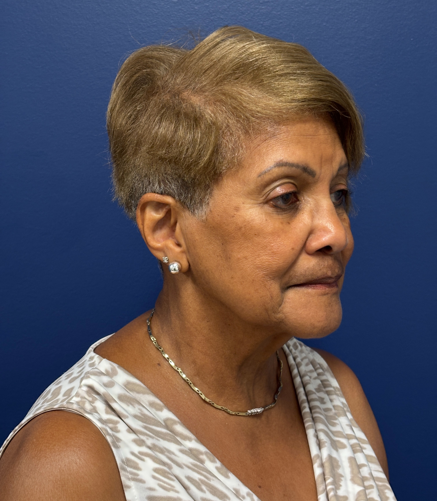 Facelift-Facial-Fat-Graft-Neck-Lift-Case--4262 | Before Face360 4