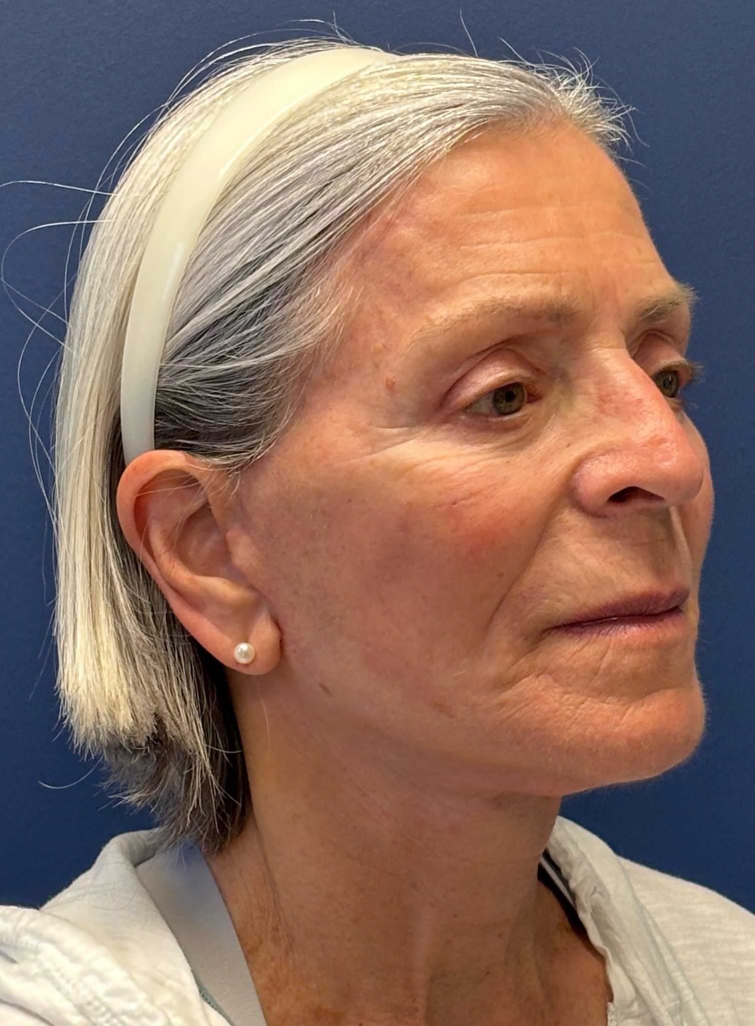 Facelift-Facial-Fat-Grafting-Browlift-Blepharoplasty-Necklift-Case--4176 | After Brow Lift 3