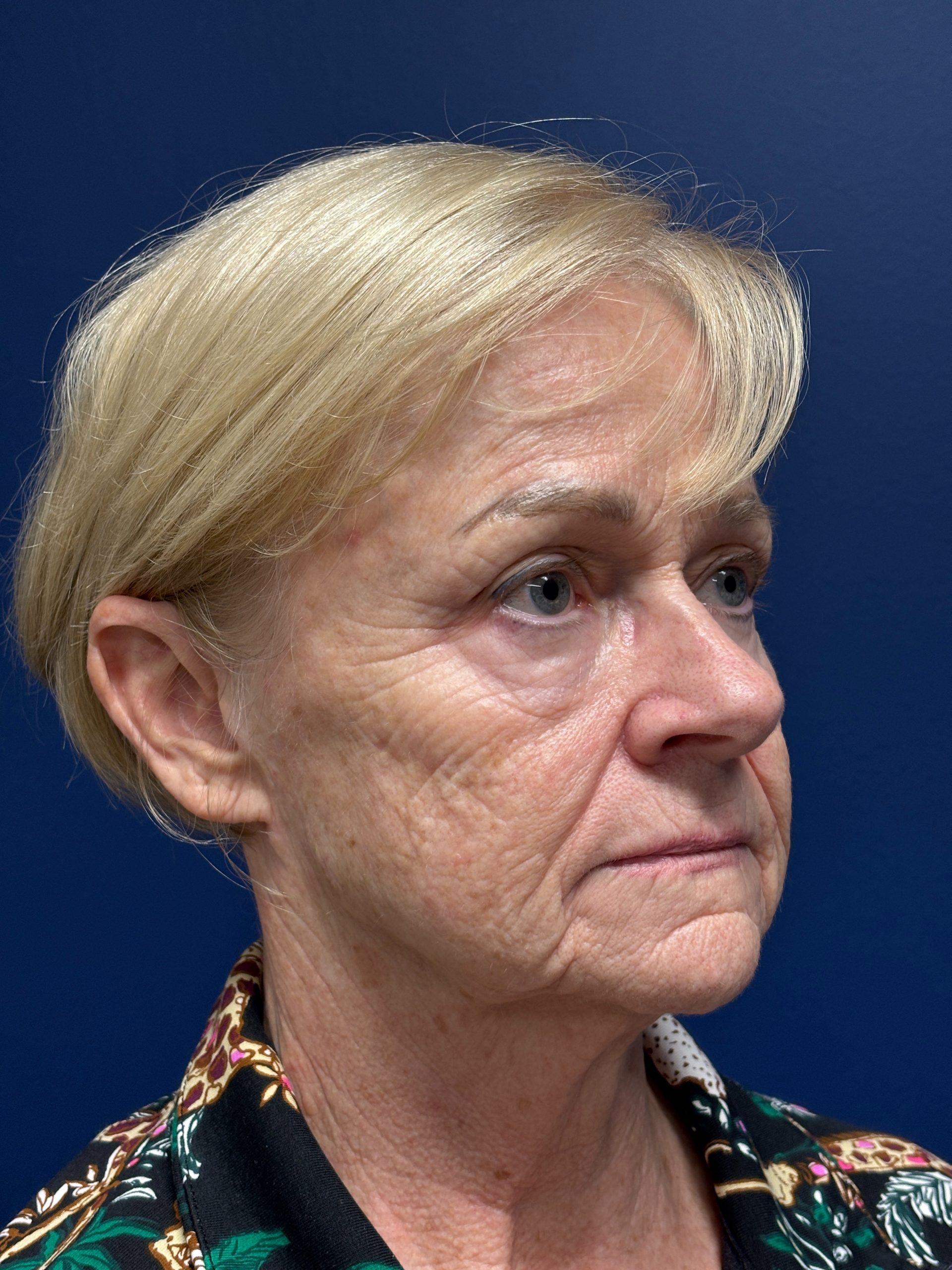 Facelift-360-Facial-Fat-Grafting-Blepharoplasty-Brow-and-Neck-Lift-Case--1433 | Before Face360 2