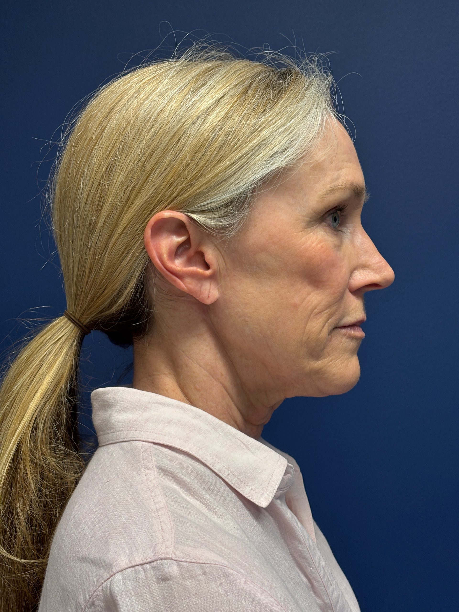 Facelift-Facial-Fat-Grafting-Brow-and-Neck-Lift-Case--9593 | Before Face360 2