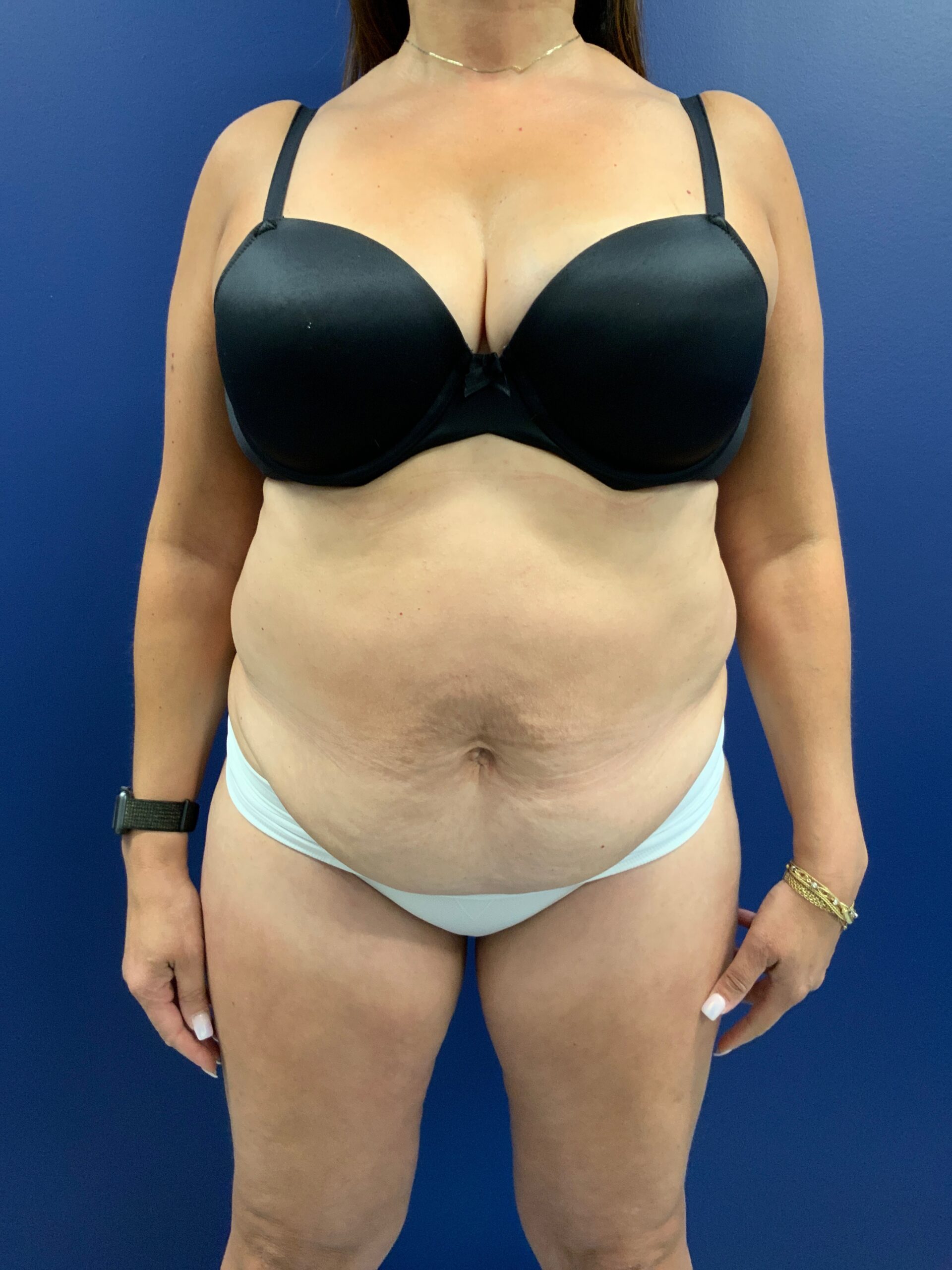 Abdominoplasty-Case--21804 | Before Body 1