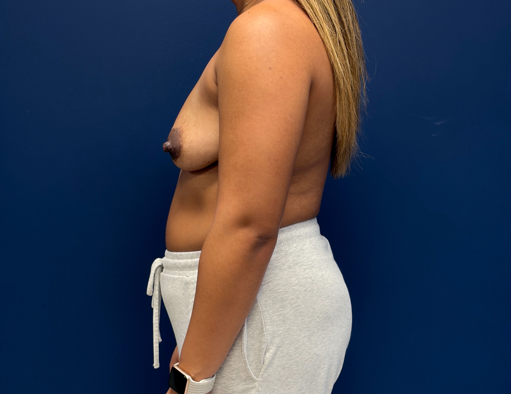 Breast-Augmentation-Case--3666 | Before Dr. Samir Rao 2