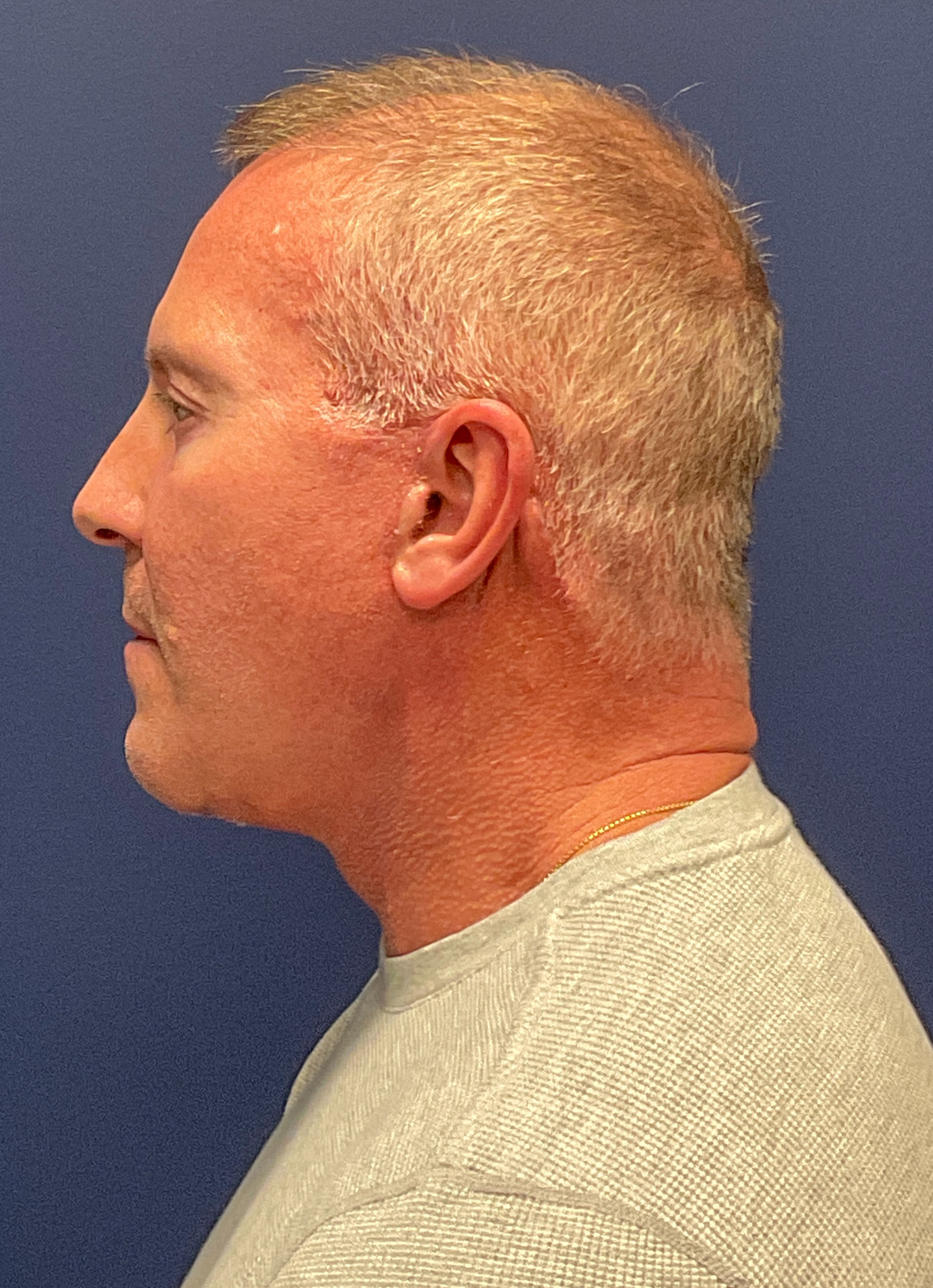 Facelift-Necklift-Blepharoplasty-Case--5535 | After Face360 2