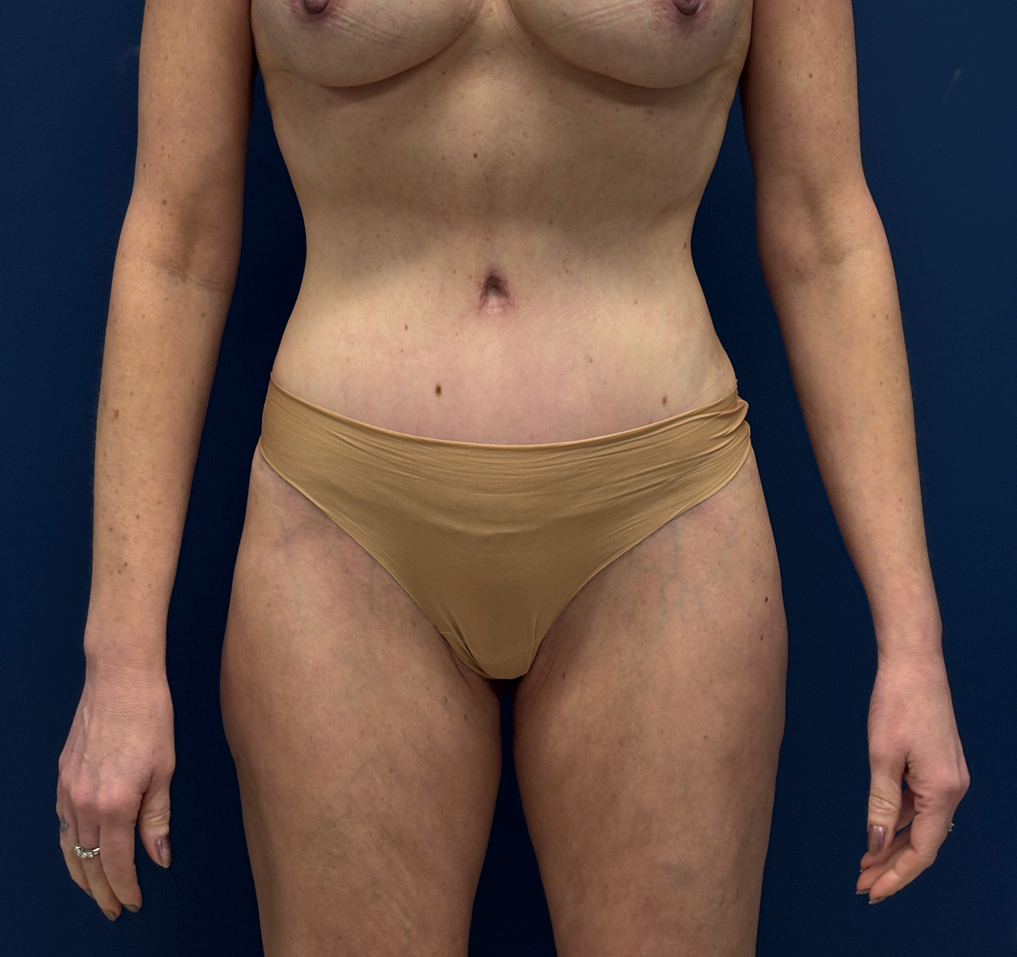 Liposuction-Case--3054 | After Body 1