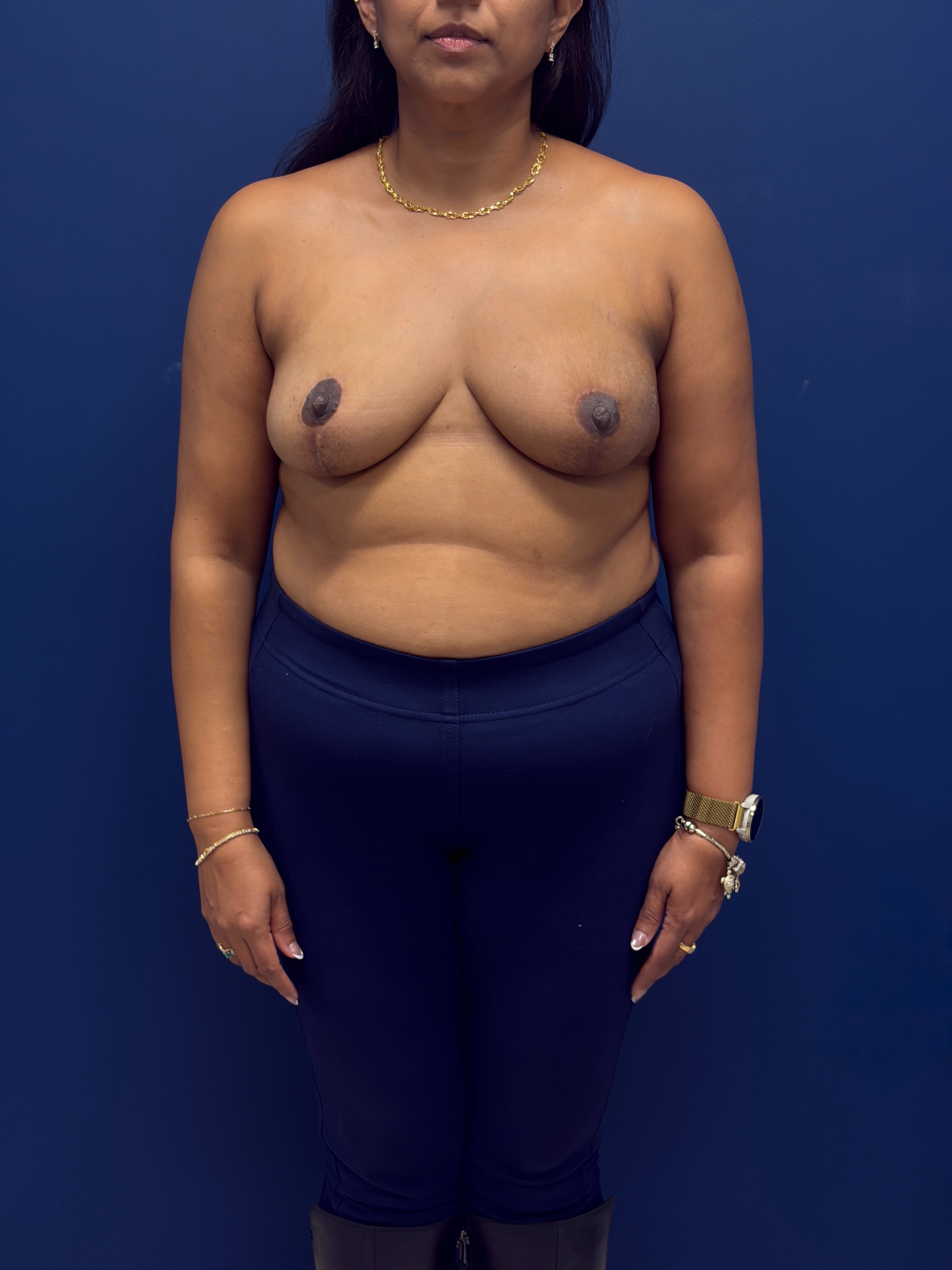 Left-Oncoplastic-Right-Reduction-Breast-Reconstruction-Case--9659 | After Breast Reconstruction 1