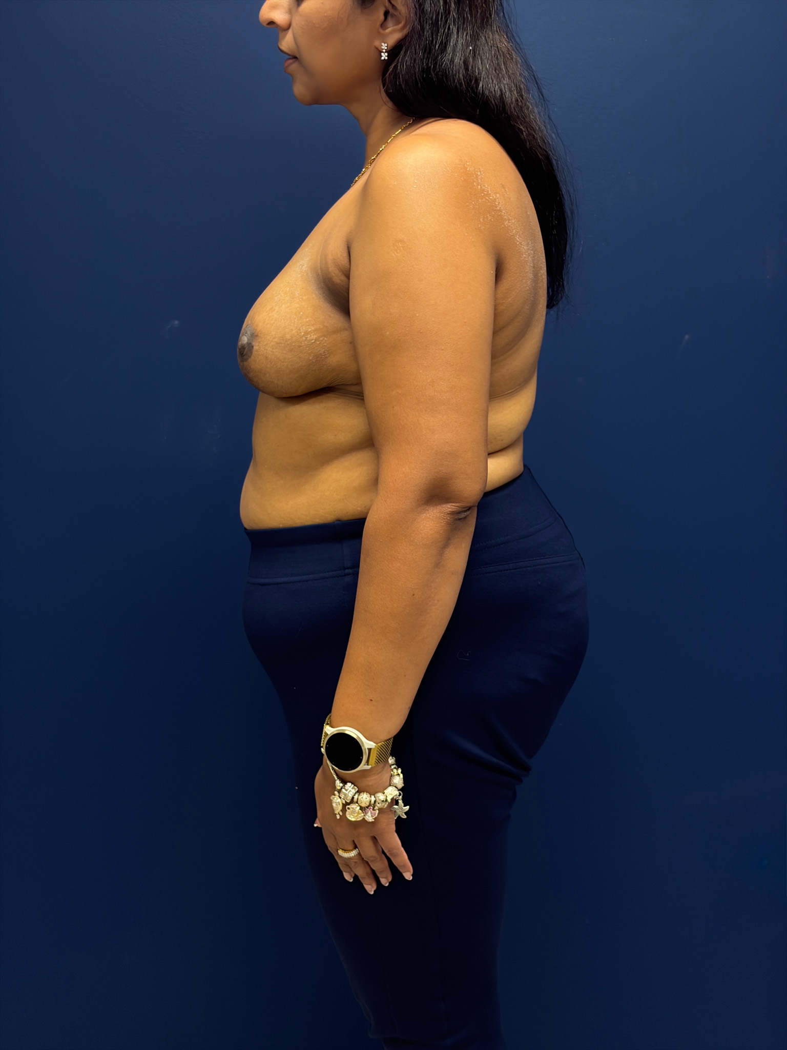 Left-Oncoplastic-Right-Reduction-Breast-Reconstruction-Case--9659 | After Breast Reconstruction 2