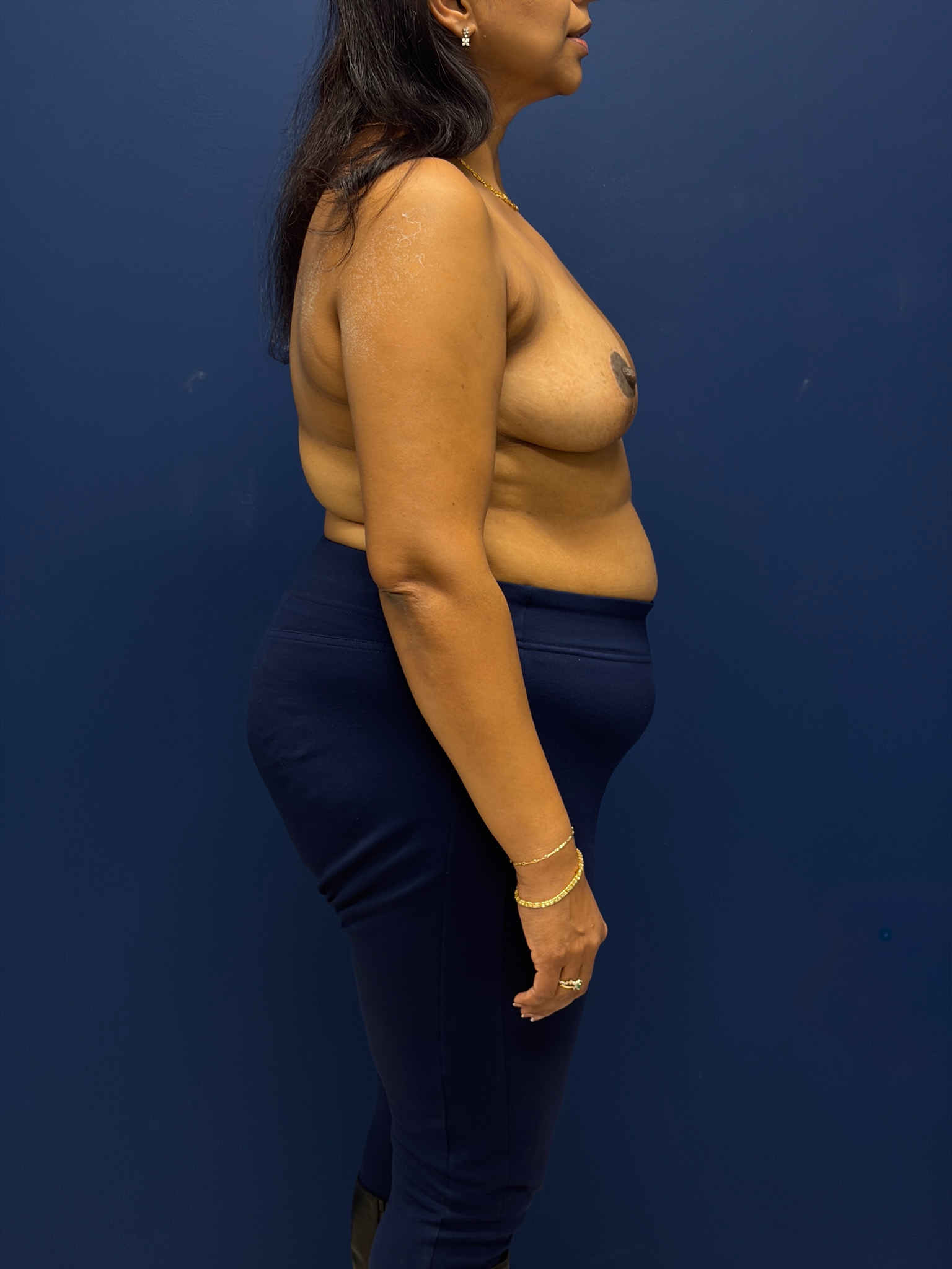 Left-Oncoplastic-Right-Reduction-Breast-Reconstruction-Case--9659 | After Breast Reconstruction 3