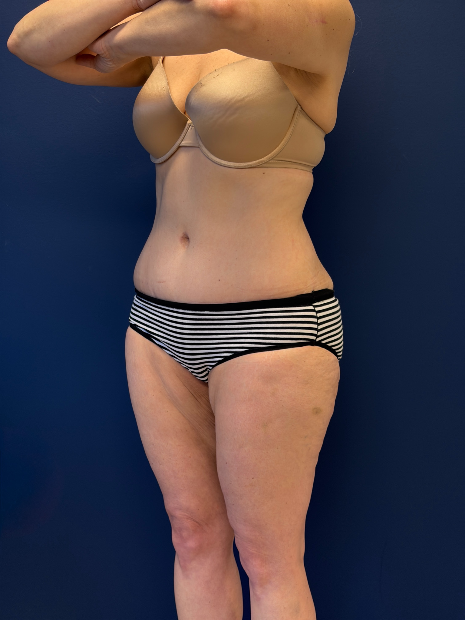 Abdominoplasty-Case--1856 | After Tummy Tuck 5