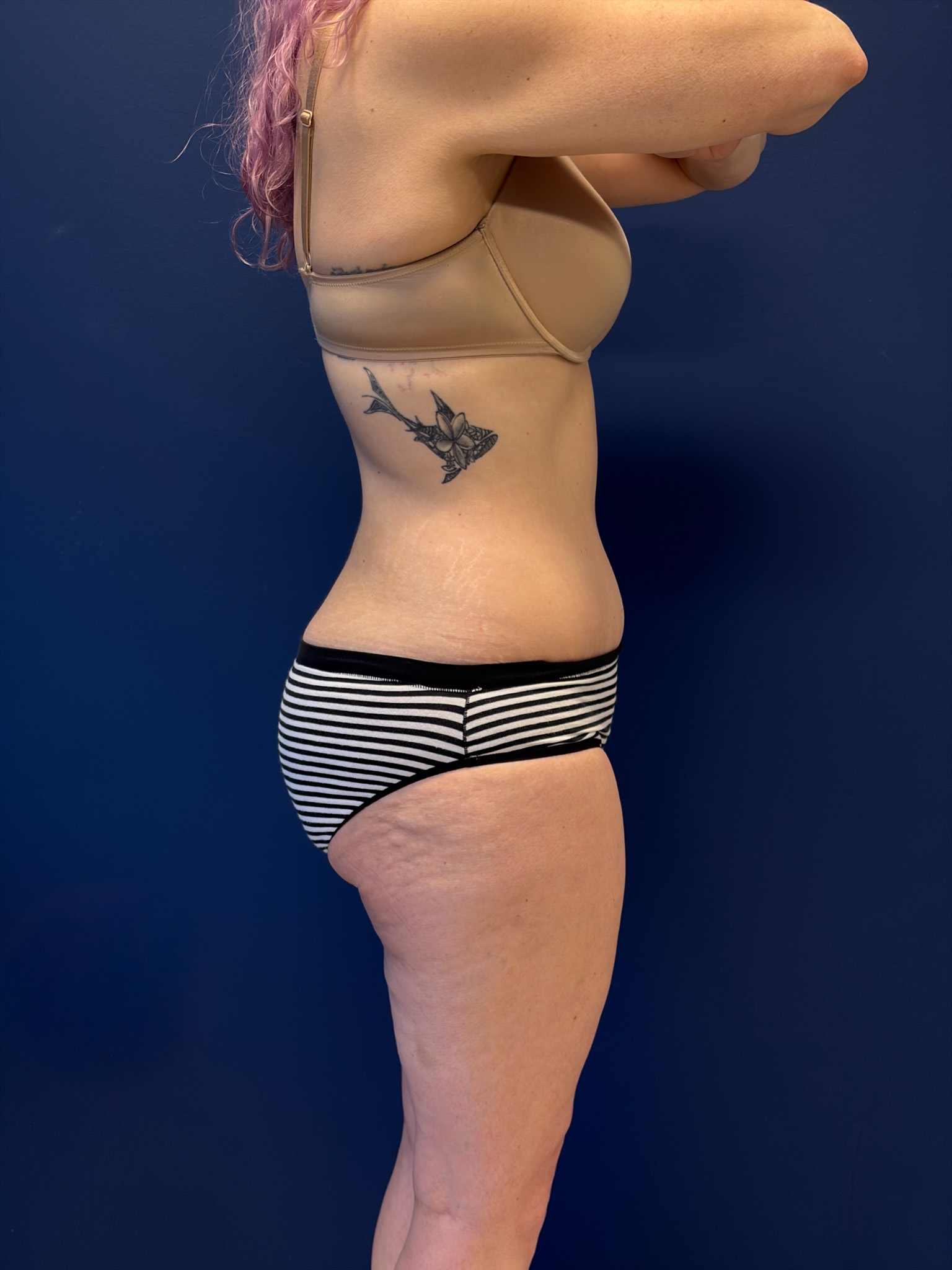 Abdominoplasty-Case--1856 | After Body 2
