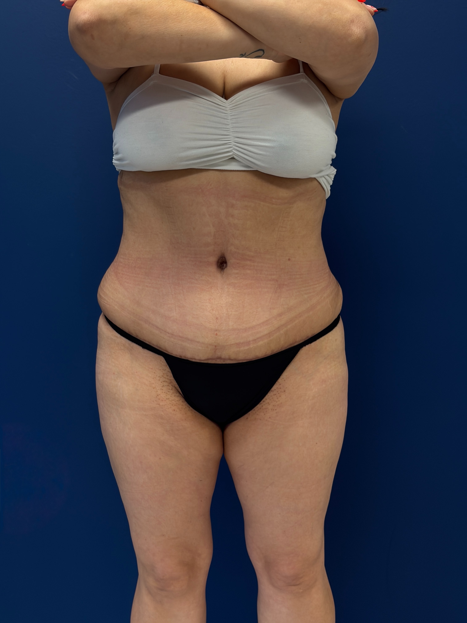 Abdominoplasty-Case--7989 | After Body 1