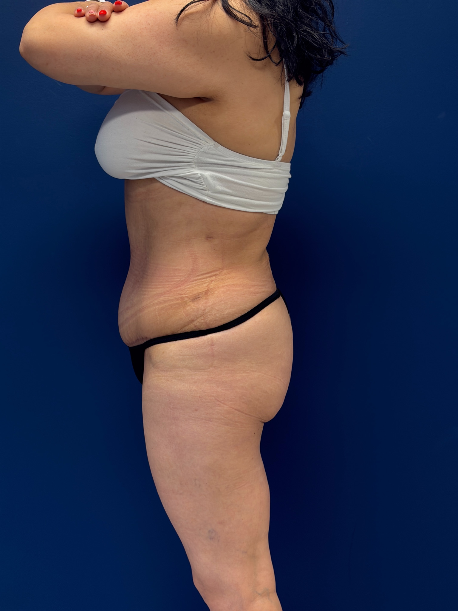 Abdominoplasty-Case--7989 | After Body 2