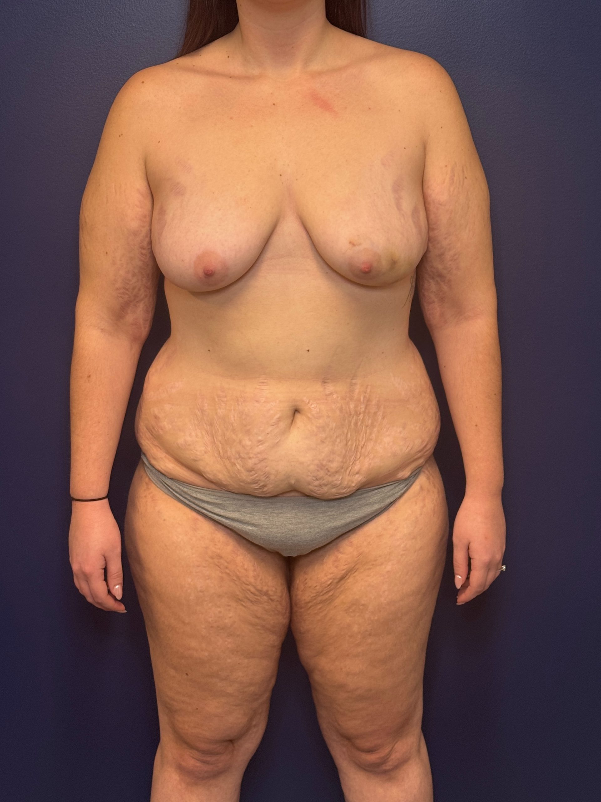 Bilateral-DIEP-Flap-Case--1108 | Before Dr. Samir Rao 1