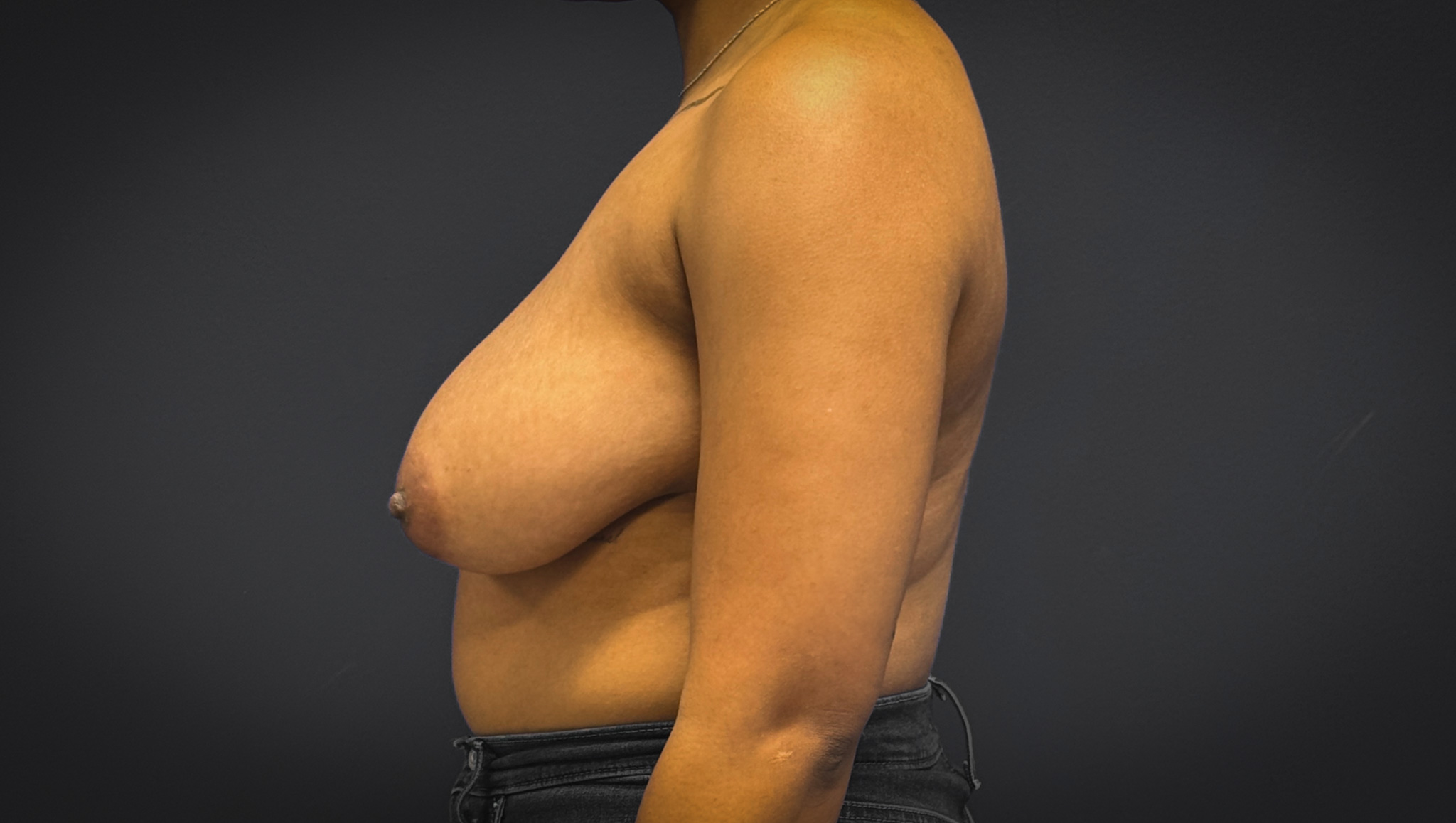 Breast-Reduction-Case--7089 | Before Breast Reduction 3