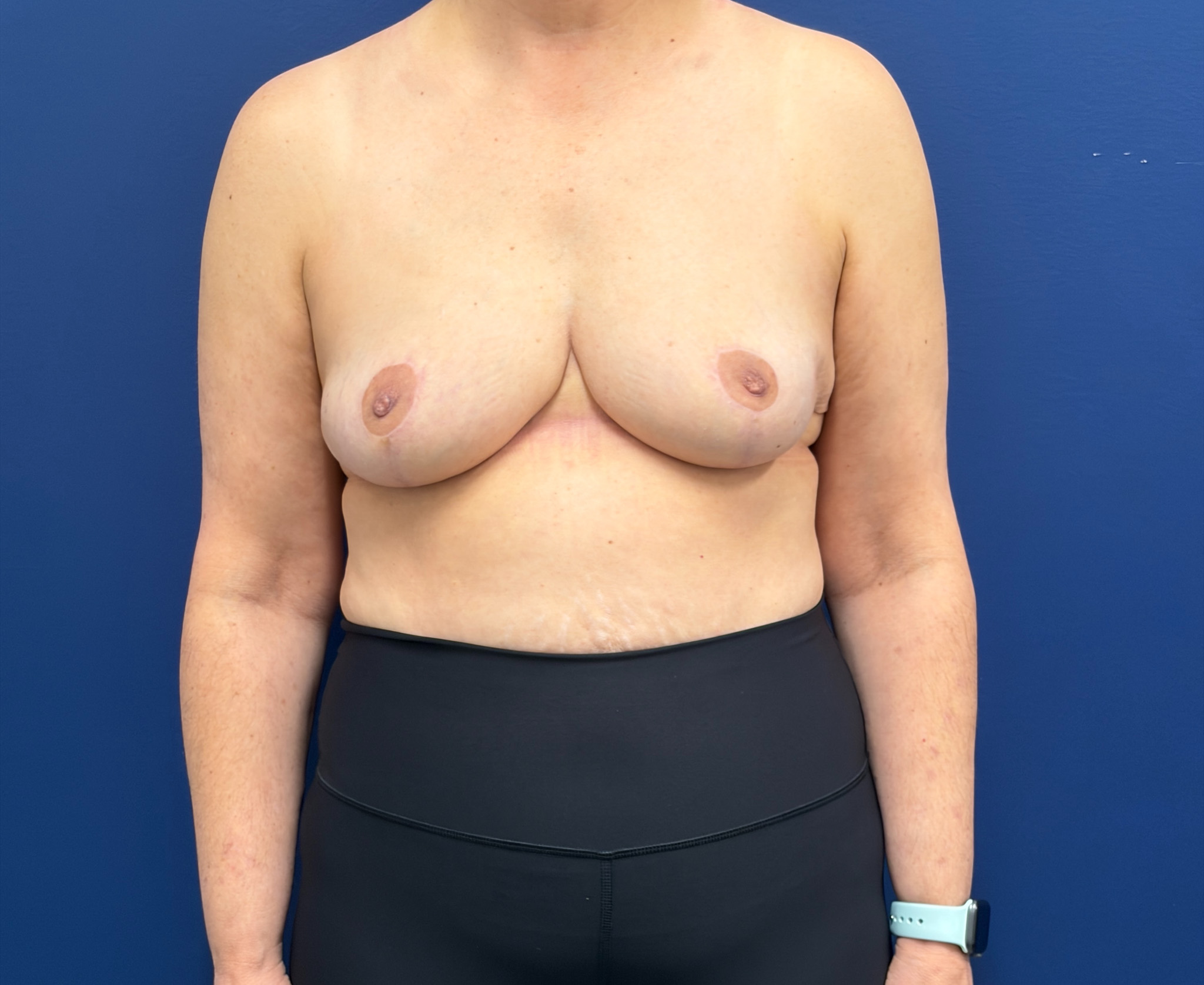 Breast-Reduction-Case--7709 | After Breast Reduction 1
