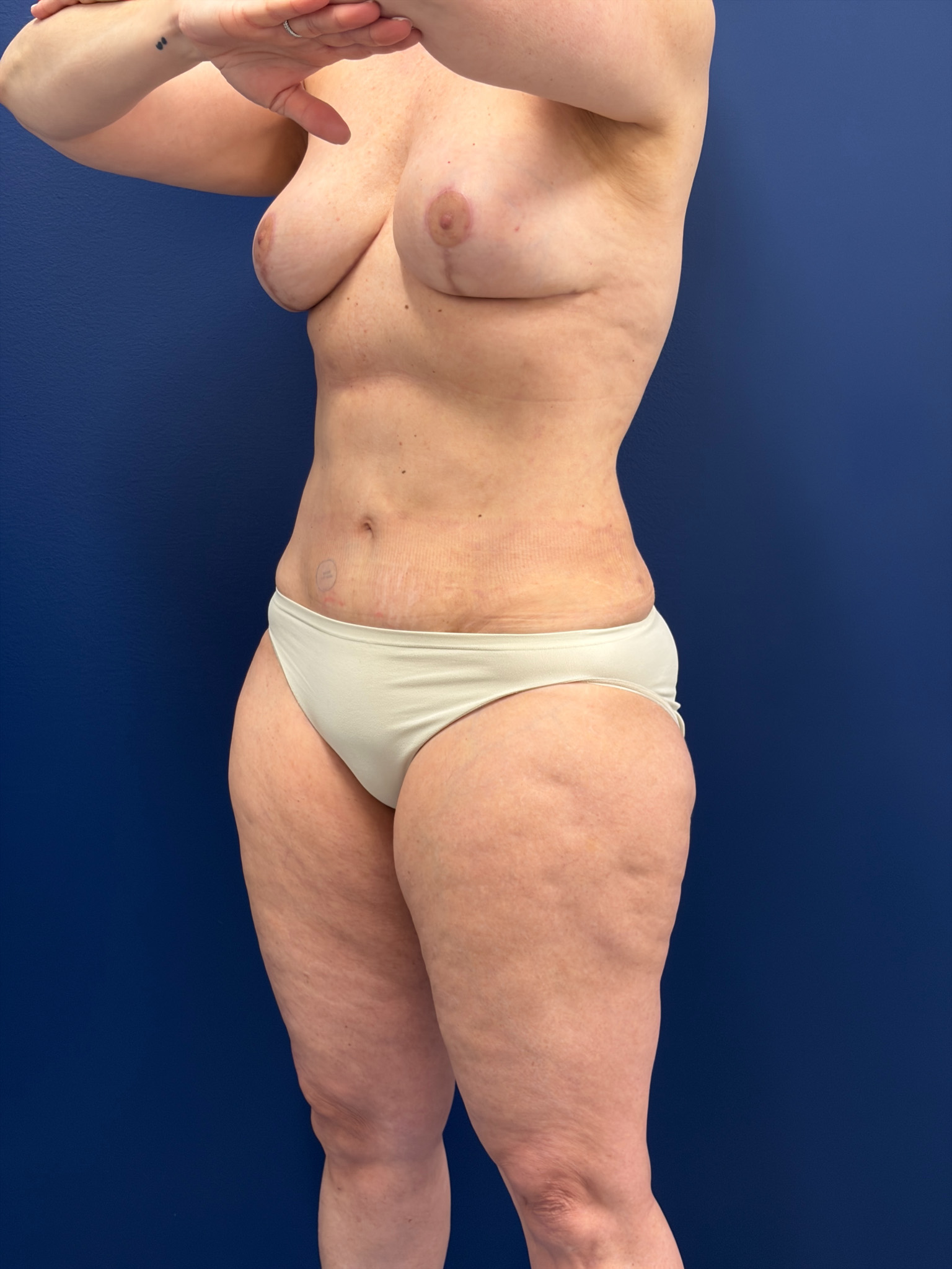 Mini-Lipoabdominoplasty-Case--9577 | After Liposuction 5