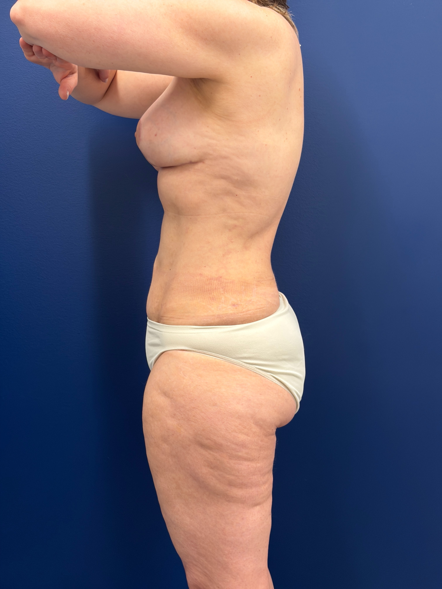 Mini-Lipoabdominoplasty-Case--9577 | After Liposuction 3