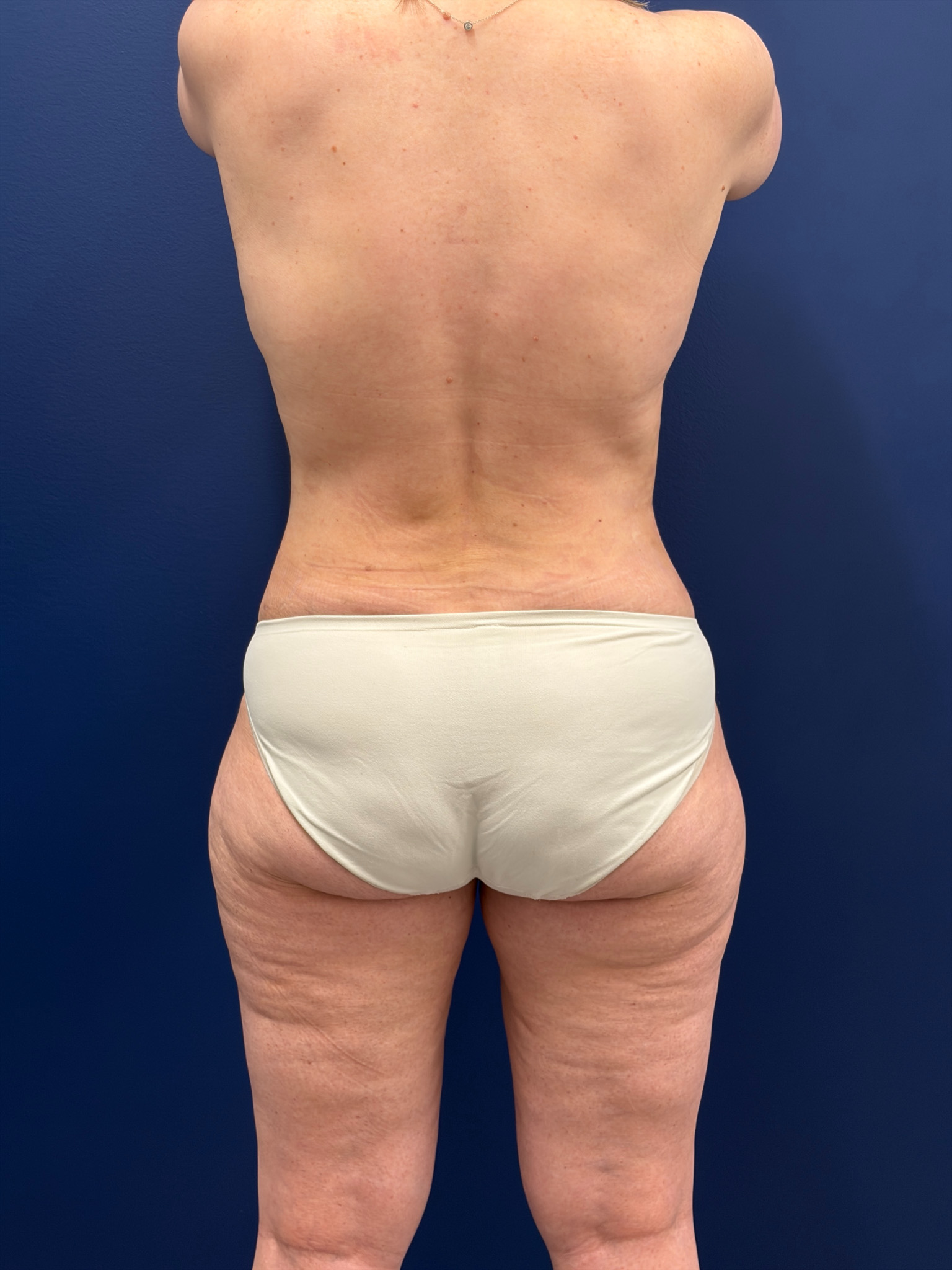 Mini-Lipoabdominoplasty-Case--9577 | After Liposuction 6