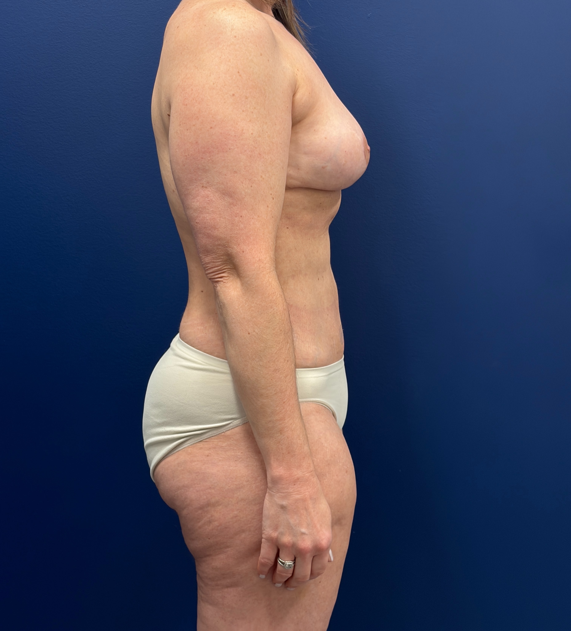 Mastopexy-with-Galaflex-Case--9485 | After Breast Lift 3