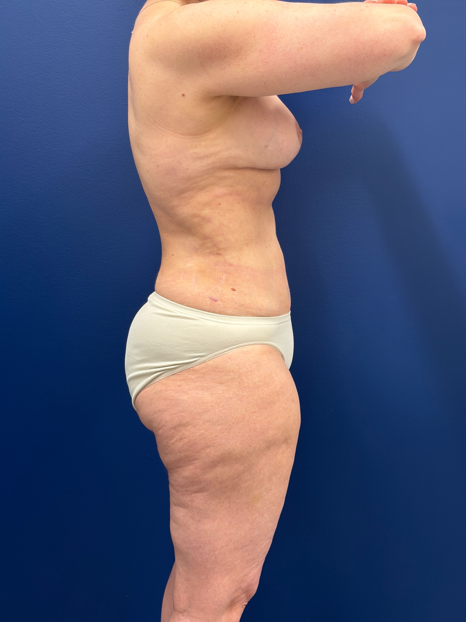 Mini-Lipoabdominoplasty-Case--9577 | After Body 2