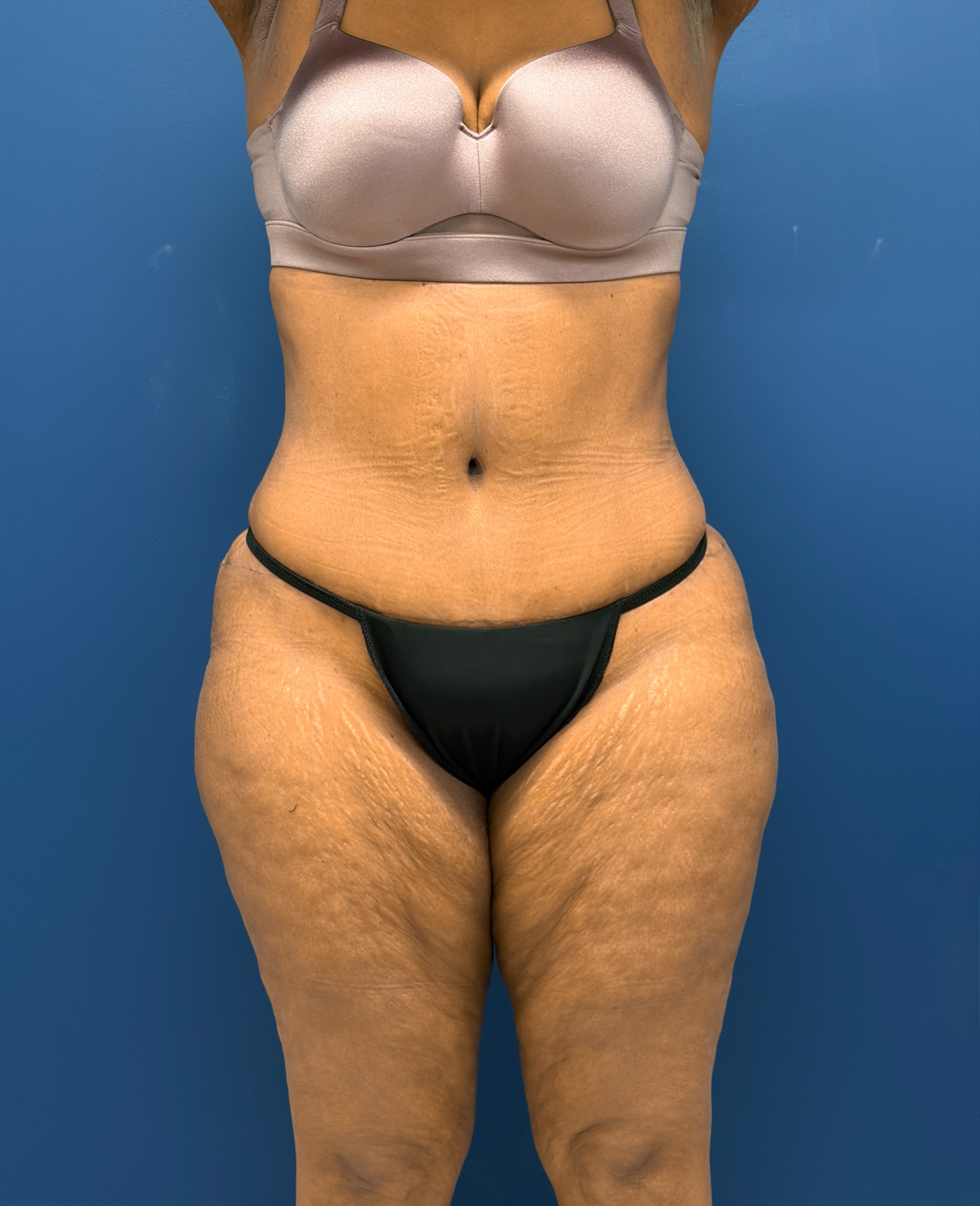 Lipoabdominoplasty-Case--6846 | After Body 1
