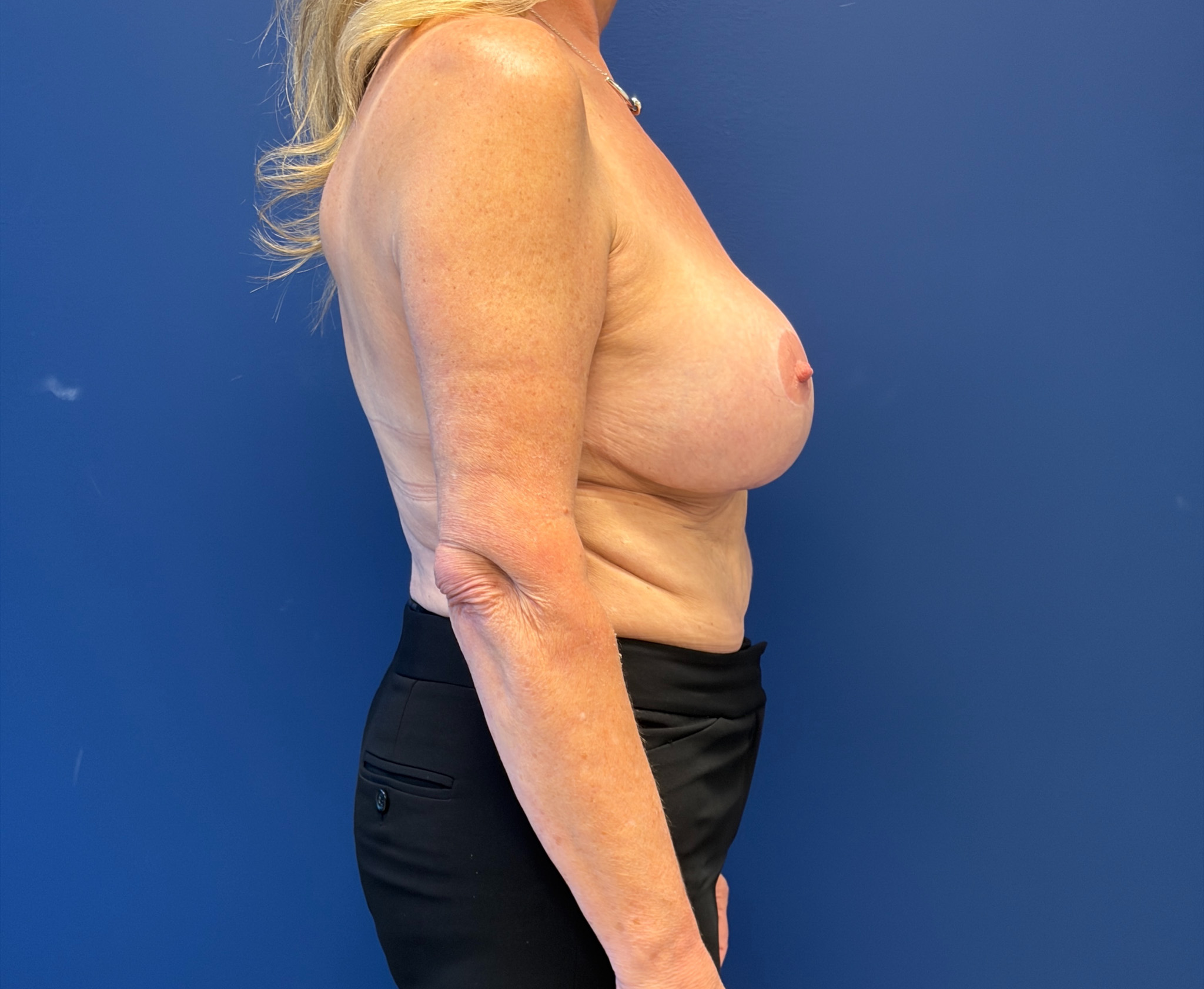 Preserv---Breast-Augmentation-Case--2946 | After Preservé Breast Augmentation 3
