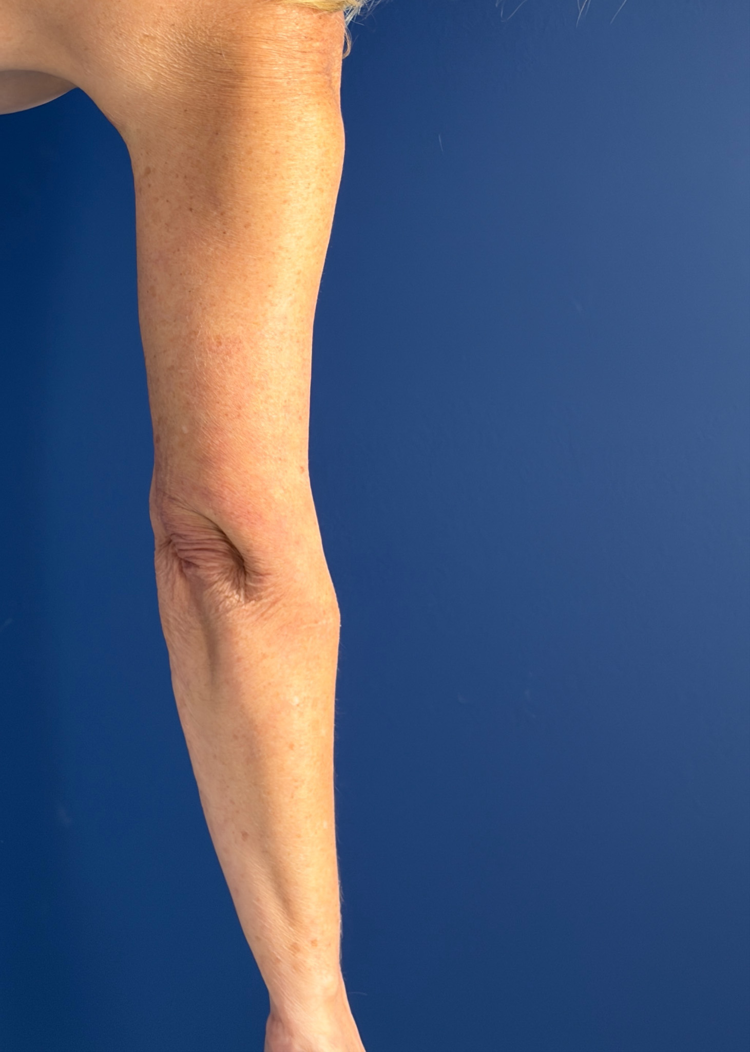 Brachioplasty-Case--4934 | After Arm Lift 4