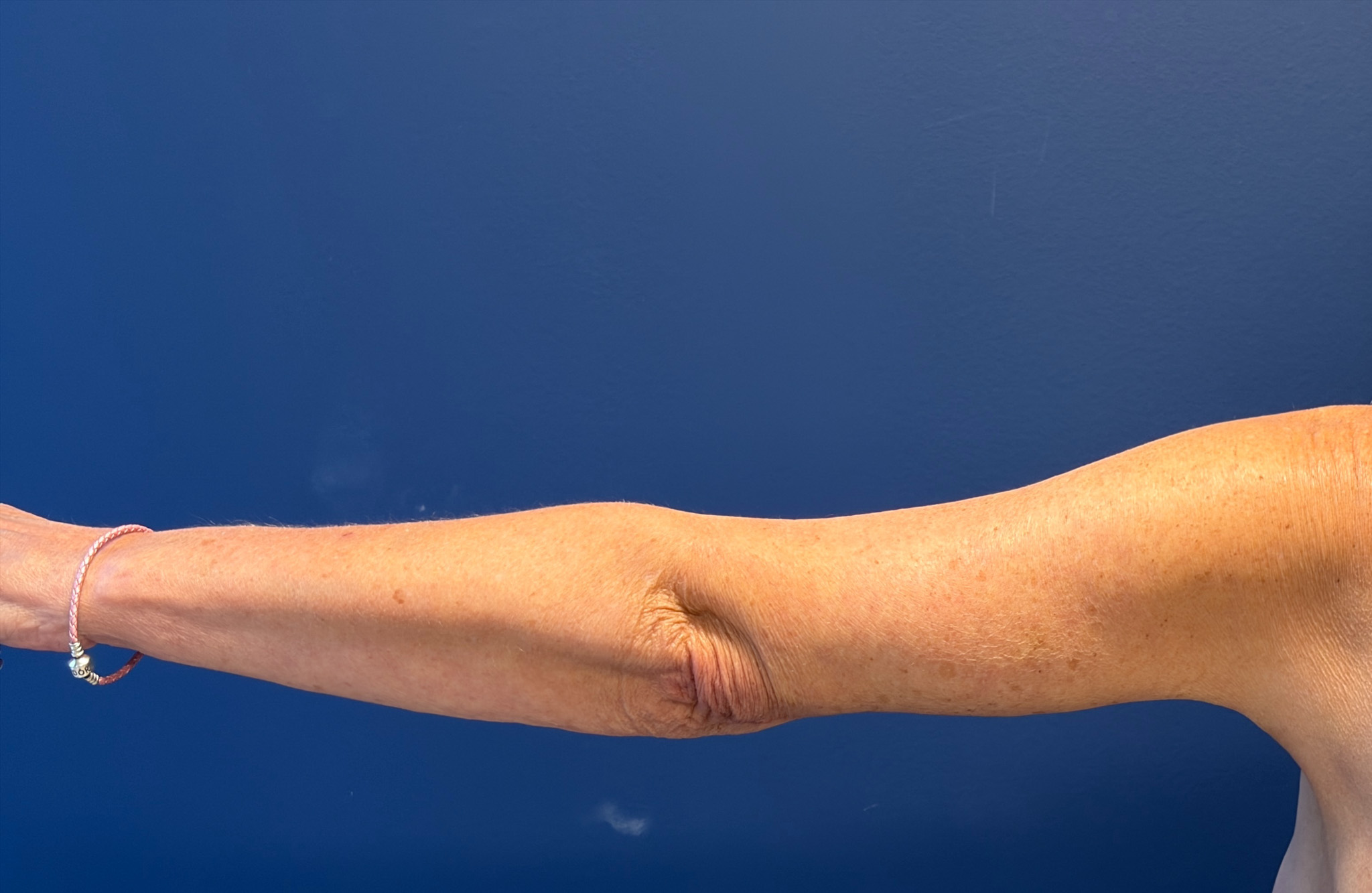 Brachioplasty-Case--4934 | After Arm Lift 3