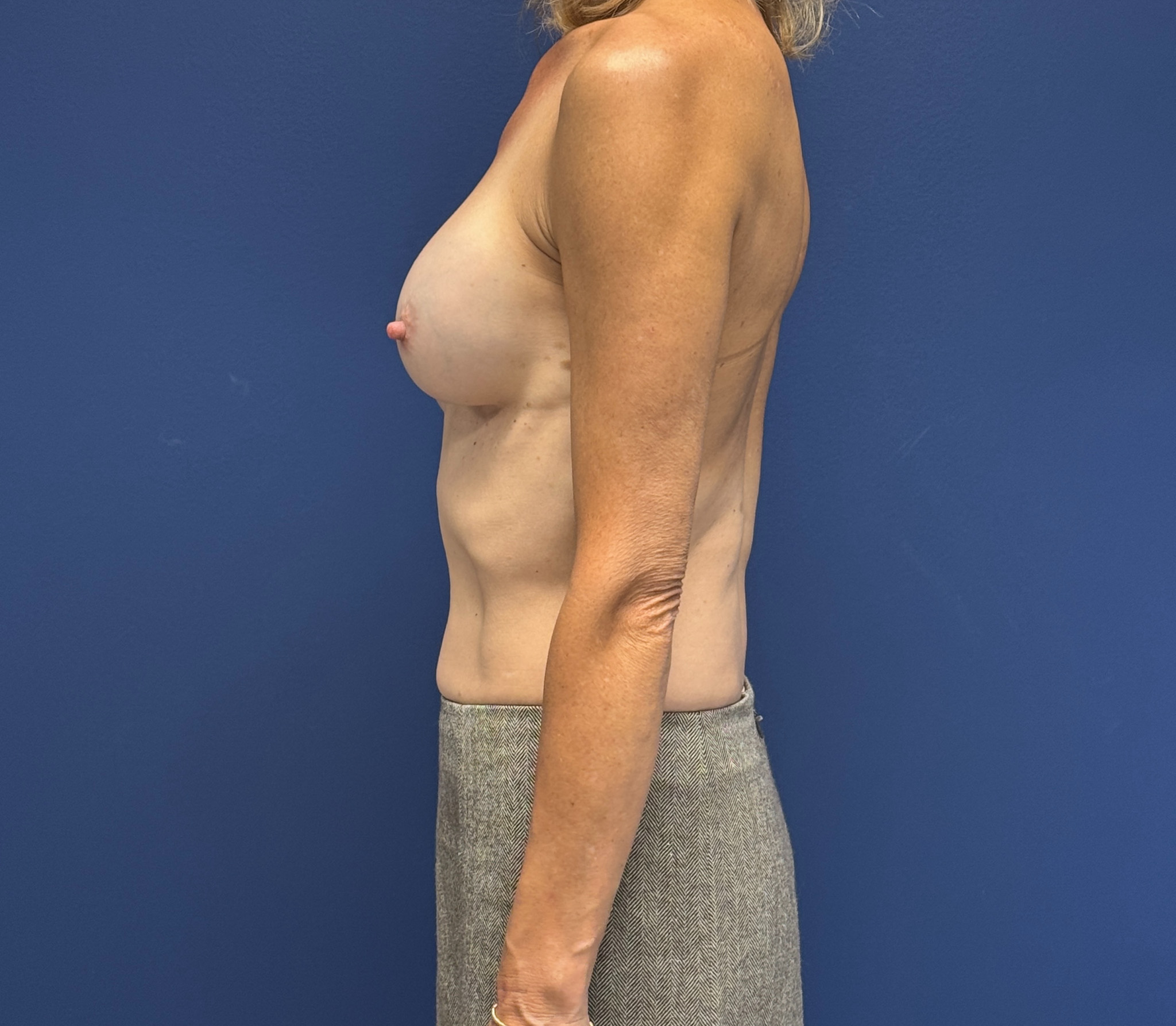 Revision-Breast-augmentation-Case--4318 | Before Revision Augmentation 3