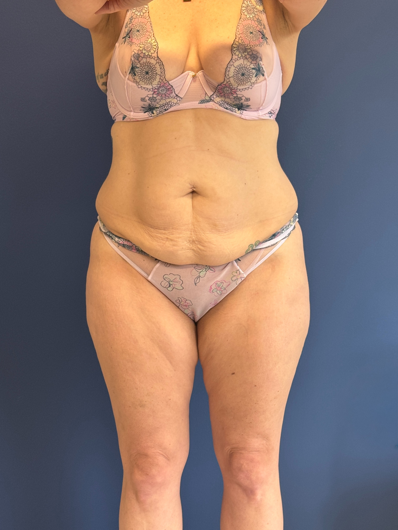 Abdominoplasty-Case--1856 | Before Body 1