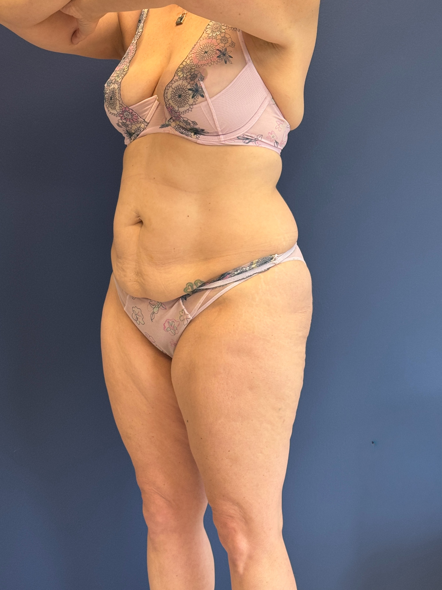 Abdominoplasty-Case--1856 | Before Tummy Tuck 5