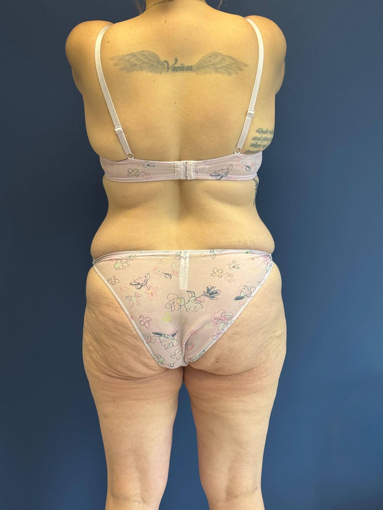 Abdominoplasty-Case--1856 | Before Tummy Tuck 6