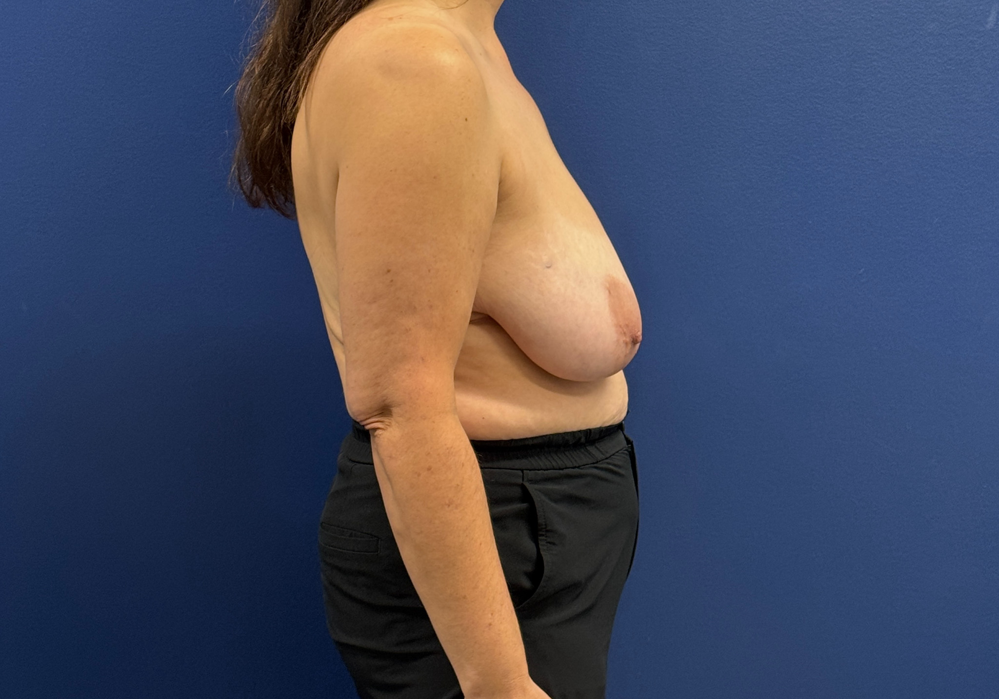 Breast-Reduction-Case--7709 | Before Breast Reduction 3