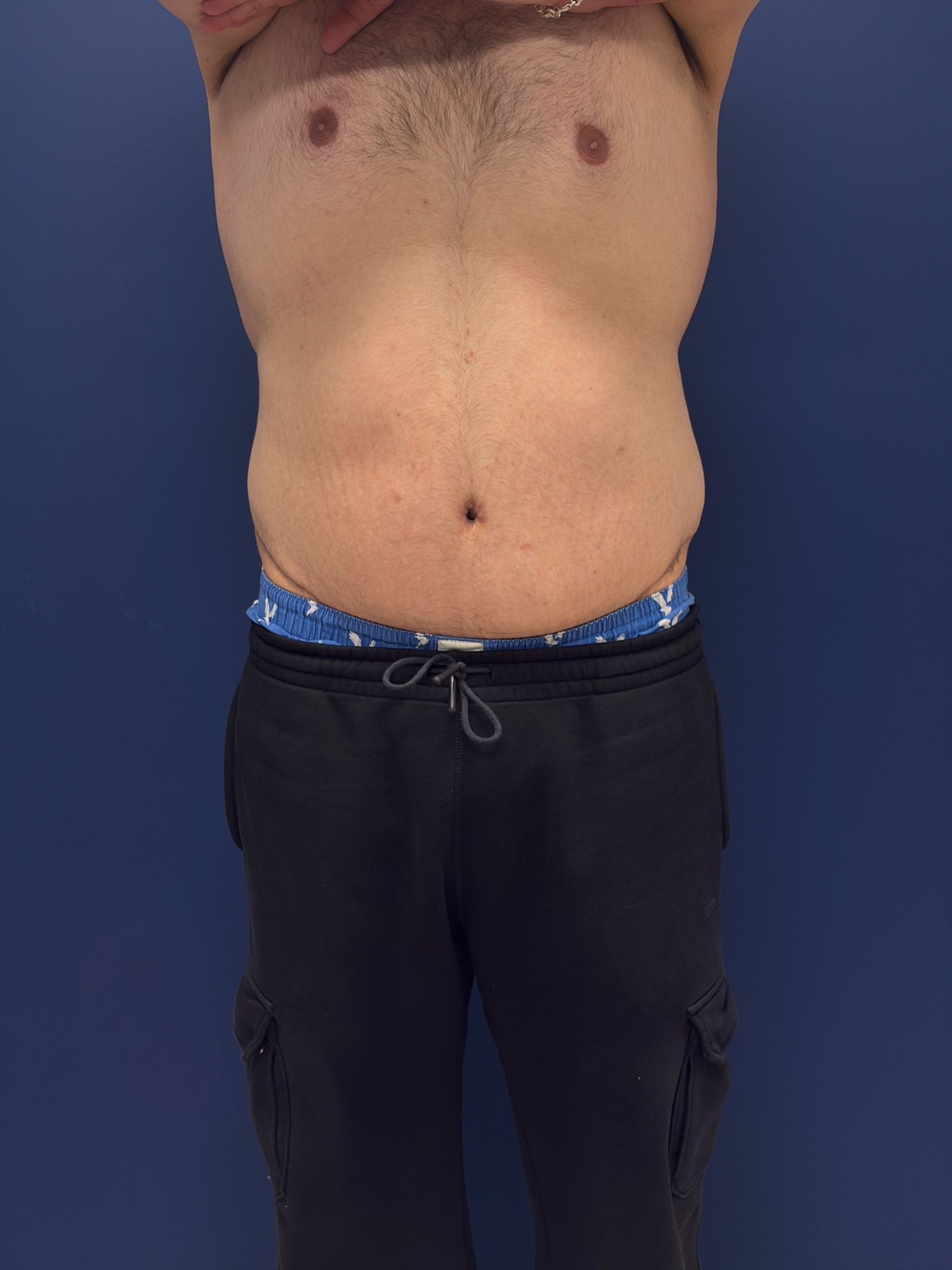 Body-Lift-Case--1927 | After Body 1