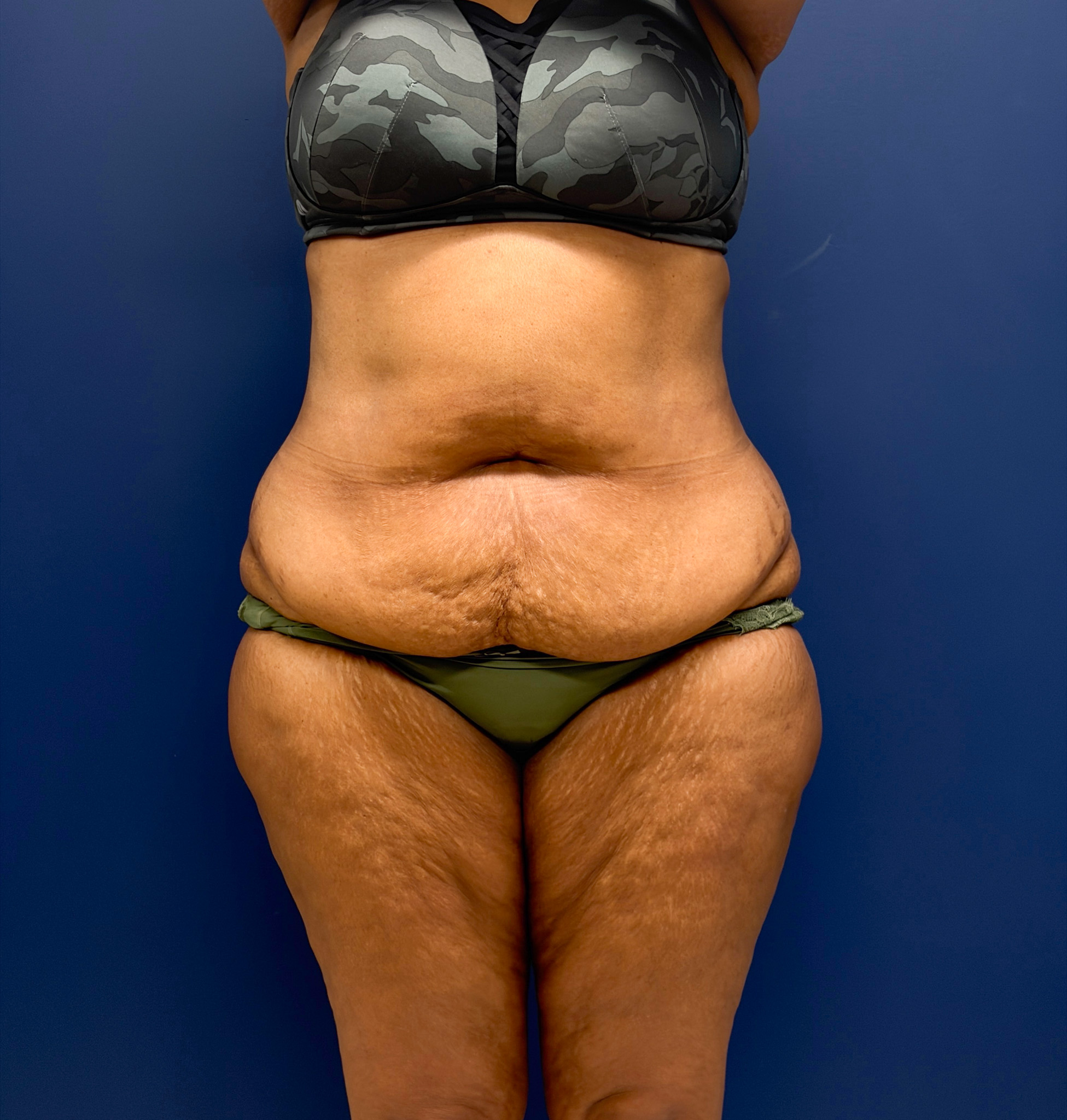 Lipoabdominoplasty-Case--6846 | Before Body 1