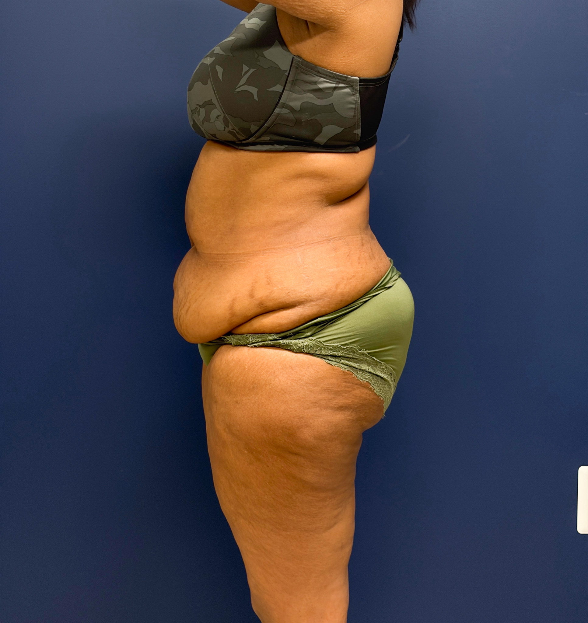 Lipoabdominoplasty-Case--6846 | Before Body 2