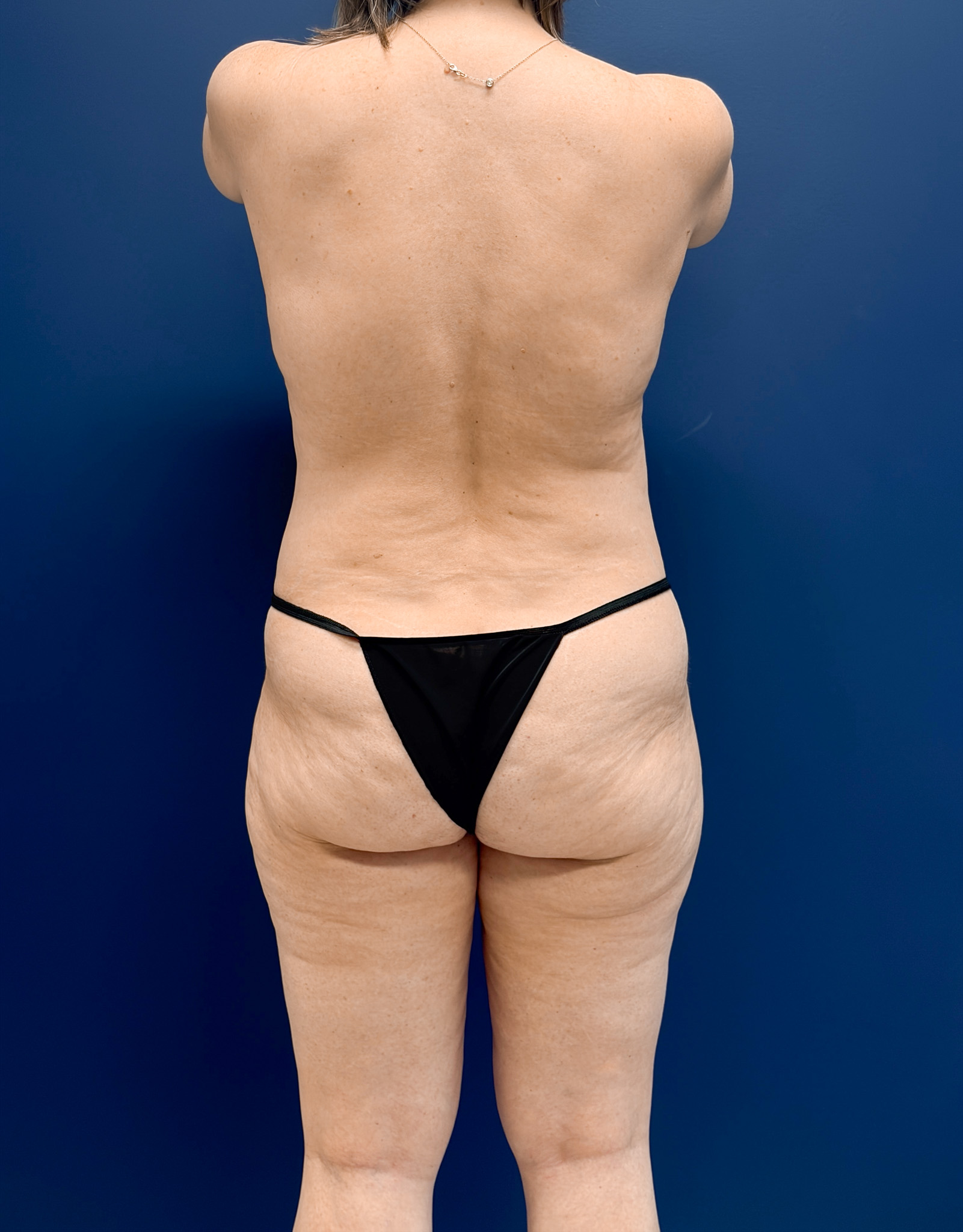 Mini-Lipoabdominoplasty-Case--9577 | Before Liposuction 6